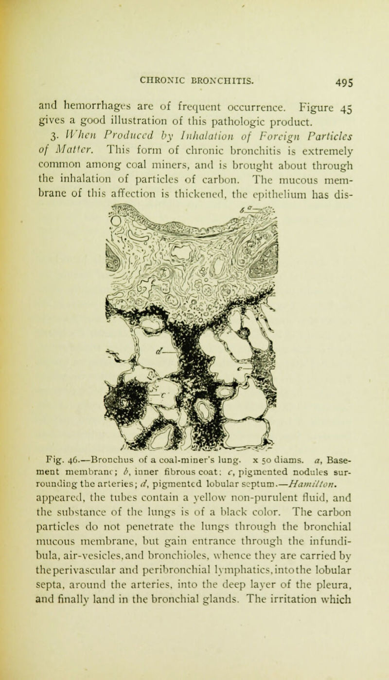 and hemorrhages arc of frequent occurrence. Figure 45 gives a good illustration of this pathologic product. 3. IVIicn Produced by Inhalation of Foreign Particles of Matter. This form of chronic bronchitis is extremely common among coal miners, and is brought about through the inhalation of particles of carbon. The mucous mem- brane of this affection is thickened, the epithelium has dis- ^^^, Fig. 4G.—Bronchus of a coal-miner's lung, x 50 Jiams. u, Base- ment mombrani; /', inner fibrous coat; f, pigmented noduks sur- rounding the arteries; tf, pigmented lobular septum.—Hamillon. appeared, the tubes contain a yellow non-purulent fluid, and the sul^tance of the lungs is of a lilack color. The carbon particles do not penetrate the lungs through the bronchial mucous membrane, but gain entrance through the infundi- bula. air-vesieles.antl bronchioles, whence they are carried bv the perivascular and peribronchial lymphatics, intothe lobular septa, around the arteries, into the tleep layer of the pleura, and finally land in the bronchial glands. The irritation which