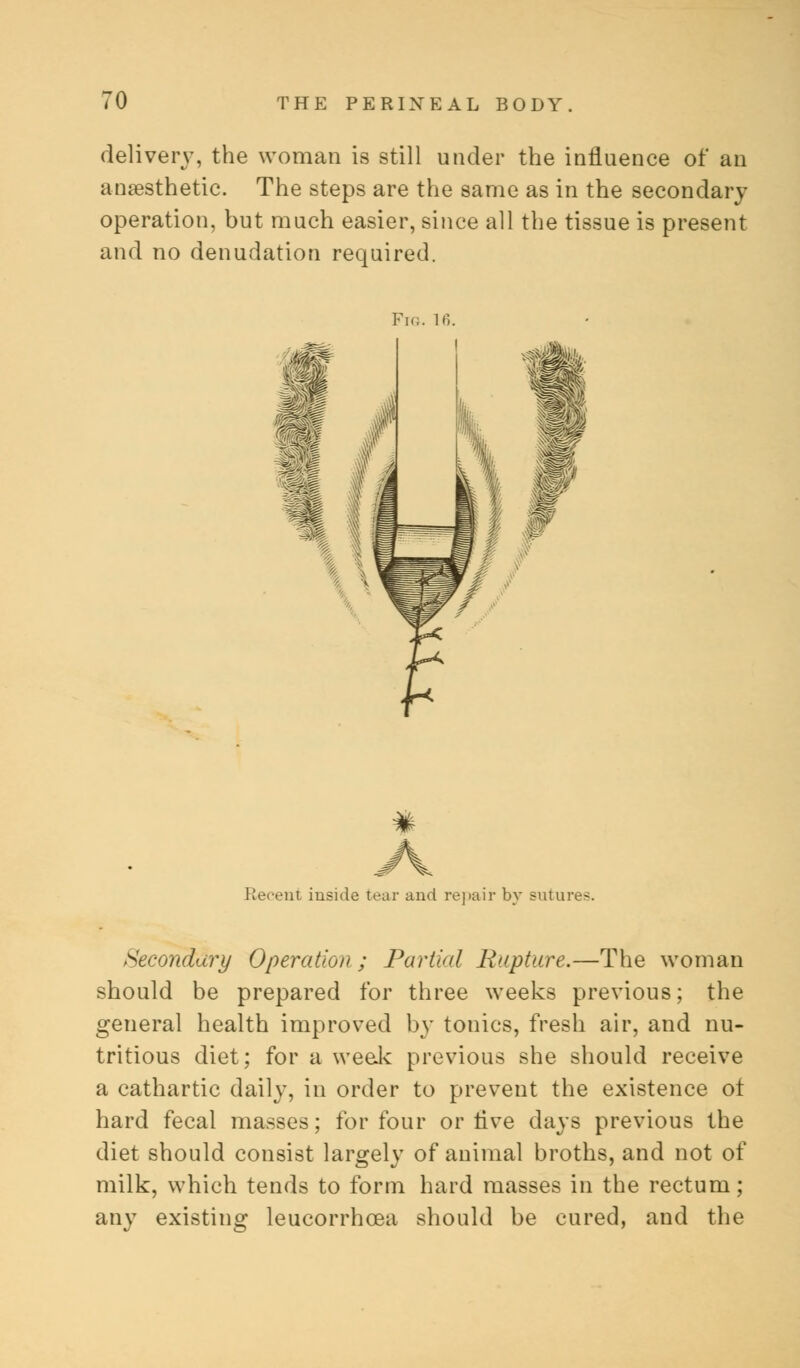 delivery, the woman is still under the influence of an anaesthetic. The steps are the same as in the secondary operation, but much easier, since all the tissue is present and no denudation required. Fig. 16. $ IP Ml A I f % Recent inside tear and repair by sutures. Secondary Operation; Partial Rapture.—The woman should be prepared for three weeks previous; the general health improved by tonics, fresh air, and nu- tritious diet; for a weak previous she should receive a cathartic daily, in order to prevent the existence ot hard fecal masses; for four or Ave days previous the diet should consist largely of animal broths, and not of milk, which tends to form hard masses in the rectum; any existing leucorrhcea should be cured, and the