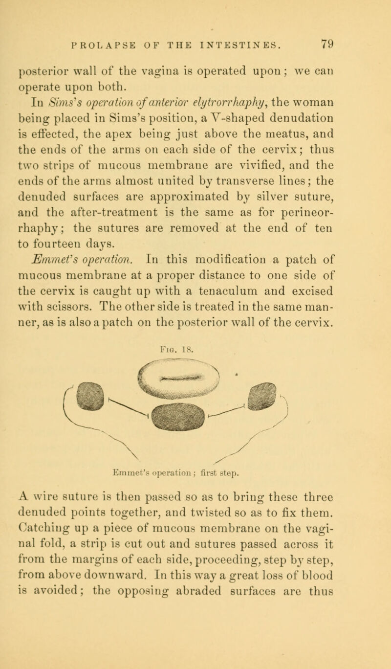 posterior wall of the vagina is operated upon; we can operate upon both. In Sims's operation of anterior elytrorrhaphy, the woman being placed in Sims's position, a Y-shaped denudation is effected, the apex being just above the meatus, and the ends of the arms on each side of the cervix; thus two strips of mucous membrane are vivified, and the ends of the arms almost united by transverse lines; the denuded surfaces are approximated by silver suture, and the after-treatment is the same as for perineor- rhaphy ; the sutures are removed at the end of ten to fourteen days. Emmet's operation. In this modification a patch of mucous membrane at a proper distance to one side of the cervix is caught up with a tenaculum and excised with scissors. The other side is treated in the same man- ner, as is also a patch on the posterior wall of the cervix. Fig. is. Emmet's operation ; firs! step. A wire suture is then passed so as to bring these three denuded points together, and twisted so as to fix them. ( atching up a piece of mucous membrane on the vagi- nal fold, a strip is cut out and sutures passed across it from the margins of each side, proceeding, step by step, from above downward. In this way a great loss of blood is avoided; the opposing abraded surfaces are thus