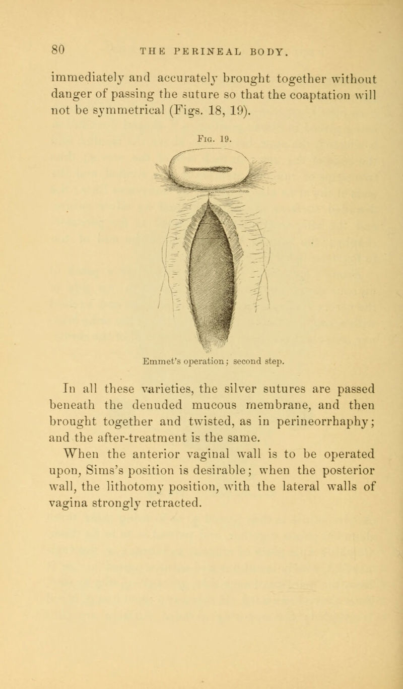 immediately and accurately brought together without danger of passing the suture so that the coaptation will not be symmetrical (Figs. 18, 19). Fig. 19. Emmet's operation; second step. In all these varieties, the silver sutures are passed beneath the denuded mucous membrane, and then brought together and twisted, as in perineorrhaphy; and the after-treatment is the same. When the anterior vaginal wall is to be operated upon, Sims's position is desirable; when the posterior wall, the lithotomy position, with the lateral walls of vagina strongly retracted.