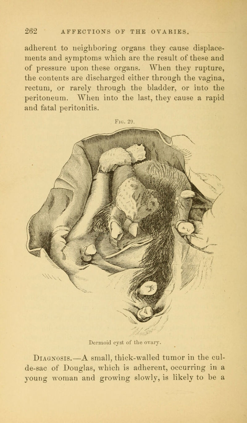 adherent to neighboring organs they cause displace- ments and symptoms which are the result of these and of pressure upon these organs. When they rupture, the contents are discharged either through the vagina, rectum, or rarely through the bladder, or into the peritoneum. When into the last, they cause a rapid and fatal peritonitis. Fig. 29. Dermoid cyst of tine ovary. Diagnosis.—A small, thick-walled tumor in the cul- de-sac of Douglas, which is adherent, occurring in a young woman and growing slowly, is likely to be a