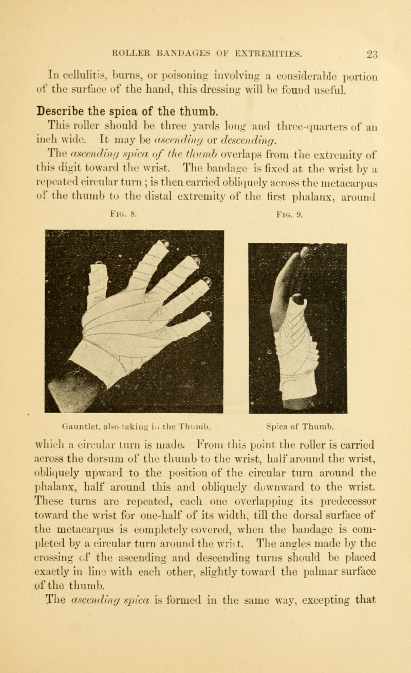 Id cellulitis, burns, or poisoning involving a considerable portion of the surface of the hand, this dressing will be found useful. Describe the spica of the thumb. This roller should be three yards long and three-quarters of an inch wide. It may he ascending or descending. The ascending spica of the thumb overlaps from the extremity of this digit toward the wrist. The bandage is fixed at the wrist by a repeated circular turn ; is then carried obliquely across the metacarpus of the thumb to the distal extremity of the first phalanx, around Fig. 8. Fig. 9. Gauntlet, also takini the Thumb. Spica of Thumb. which a circular turn is made. From this point the roller is carried across the dorsum of the thumb to the wrist, half around the wrist, obliquely upward to the position of the circular turn around the phalanx, half around this and obliquely downward to the wrist. These turns are repeated, each one overlapping its predecessor toward the wrist for one-half of its width, till the dorsal surface of the metacarpus is completely covered, when the bandage is com- pleted by a circular turn around the wrfet. The angles made by the crossing cf the ascending and descending turns should be placed exactly in line with each other, slightly toward the palmar surface of the thumb. The ascending spica is formed in the same way, excepting that