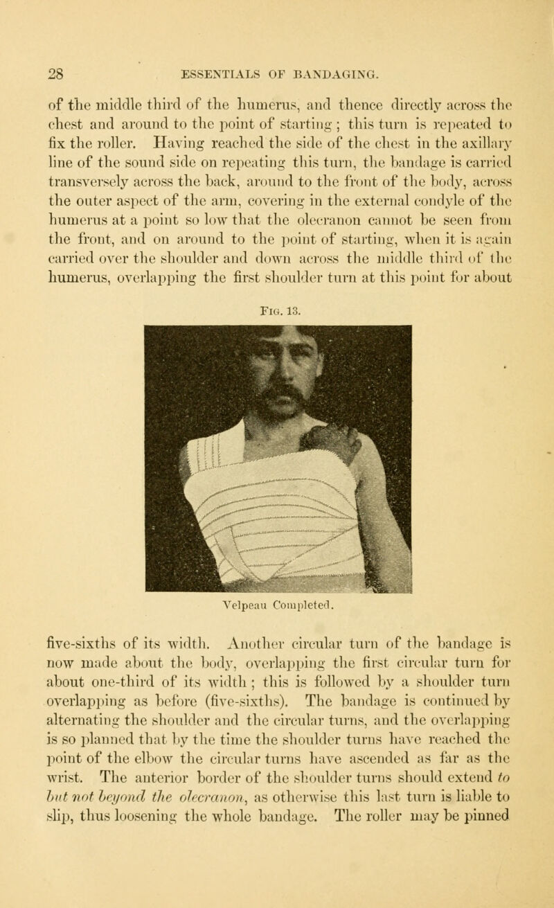 of the middle third of the humerus, and thence directly across the chest and around to the point of starting ; this turn is repeated to fix the roller. Having reached the side of the chest in the axillary line of the sound side on repeating this turn, the bandage is carried transversely across the back, around to the front of the body, across the outer aspect of the arm, covering in the external condyle of the humerus at a point so low that the olecranon cannot be seen from the front, and on around to the point of starting, when it is again carried over the shoulder and down across the middle third of the humerus, overlapping the first shoulder turn at this point for about Fig. 13. Velpeau Completed. five-sixths of its width. Another circular turn of the bandage is now made about the body, overlapping the first circular turn for about one-third of its width; this is followed by a shoulder turn overlapping as before (five-sixths). The bandage is continued by alternating the shoulder and the circular turns, and the overlapping is so planned that by the time the shoulder turns have reached the point of the elbow the circular turns have ascended as far as the wrist. The anterior border of the shoulder turns should extend to but not beyond the olecranon, as otherwise this last turn is liable to slip, thus loosening the whole bandage. The roller may be pinned