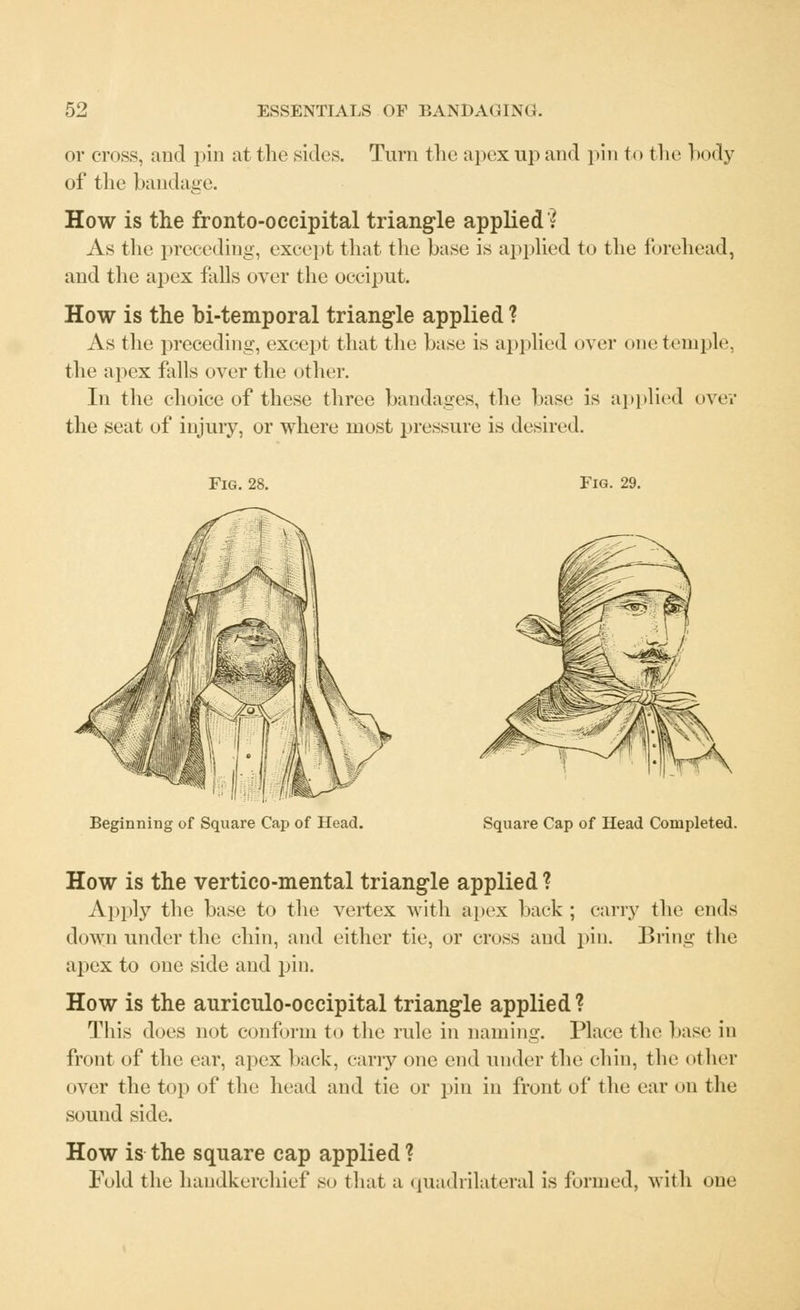 or cross, and pin at the sides. Turn the apex up and pin to the body of the bandage. How is the fronto-occipital triangle applied? As the preceding, except that the base is applied to the forehead, and the apex falls over the occiput. How is the bi-temporal triangle applied ? As the preceding, except that the base is applied over one temple, the apex falls over the other. In the choice of these three bandages, the base is applied over the seat of injury, or where most pressure is desired. Fig. 28. Fig. 29. Beginning of Square Cap of Head. Square Cap of Head Completed. How is the vertico-mental triangle applied ? Apply the base to the vertex with apex back ; carry the ends down under the chin, and either tie, or cross and pin. Bring the apex to one side and pin. How is the auriculo-occipital triangle applied? This does not conform to the rule in naming. Place the base in front of the ear, apex back, cany one end under the chin, the other over the top of the head and tie or pin in front of the ear on the sound side. How is the square cap applied ? Fold the handkerchief so that a quadrilateral is formed, with one