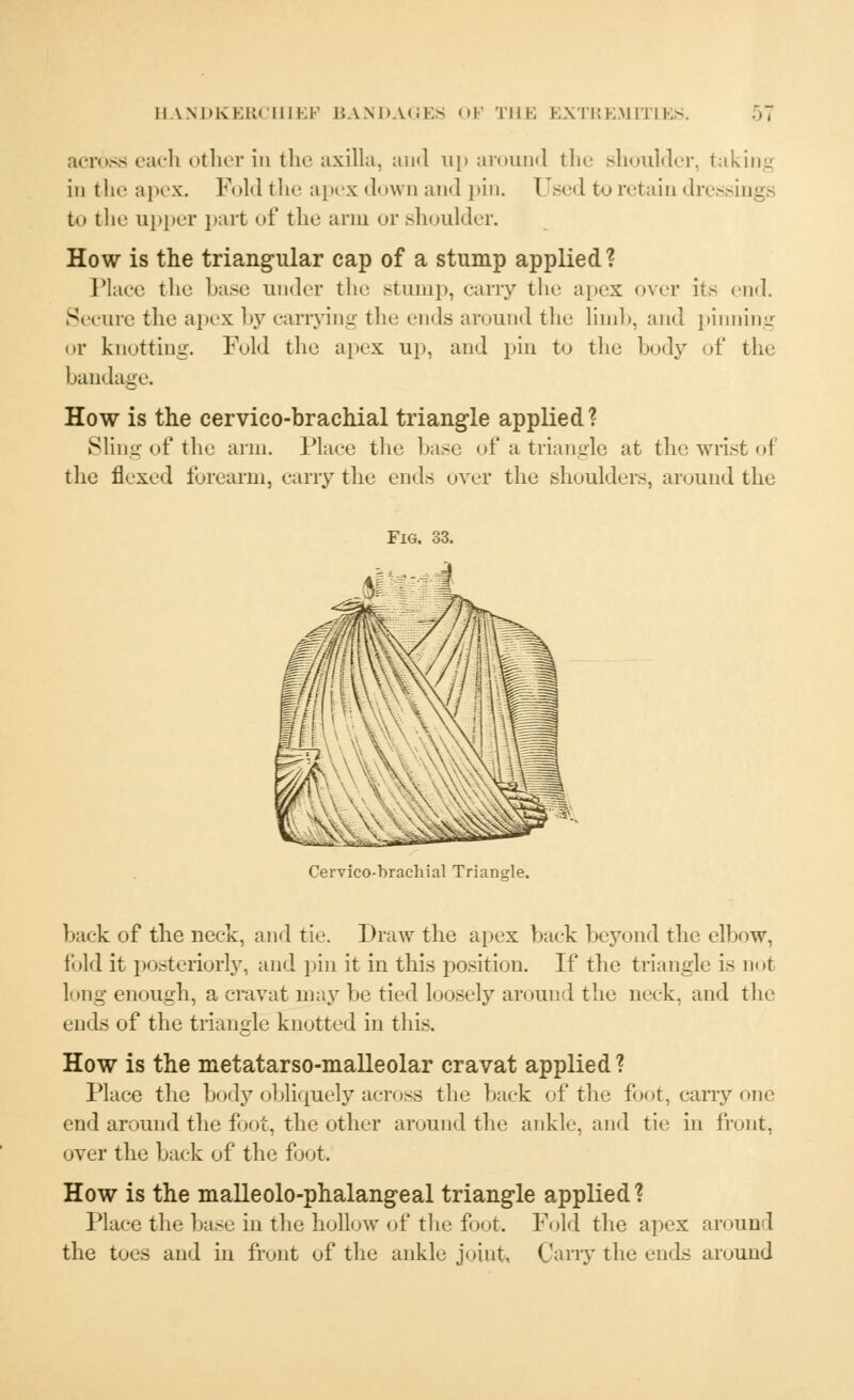 across each other in the axilla, and up around the shoulder, taking in the apex. Fold the apex down and pin. Used to retain dressings to the upper part of the arm or shoulder. How is the triangular cap of a stump applied? Place the base under the stump, carry the apex over its end. Secure the apex by carrying the ends around the limb, and pinning or knotting. Fold the apex up, and pin to the body of the bandage. How is the cervico-brachial triangle applied? Sling of the arm. Place the base of a triangle at the wrist of the flexed forearm, carry the ends over the shoulders, around the Fig. 33. Cervico-brachial Triangle. back of the neck, and tie. Draw the apex hack beyond the elbow, fold it posteriori}', and pin it in this position. If the triangle is do< long enough, a cravat may be tied loosely around the neck, and the ends of the triangle knotted in this. How is the metatarso-malleolar cravat applied ? Place the body obliquely across the back of the foot, carry one end around the foot, the other around the ankle, and tie in front, over the back of the foot. How is the malleolo-phalangeal triangle applied? Place the base in the hollow of the foot. Fold the apex around the toes and in front of the ankle joint. Carry the ends around