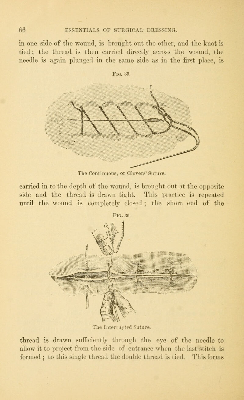 in one side of the wound, is brought out the other, and the knot is tied ; the thread is then carried directly across the wound, the needle is again plunged in the same side as in the first place, is Fig. 35. The Continuous, or Glovers' Suture. carried in to the depth of the wound, is brought out at the opposite side and the thread is drawn tight. This practice is repeated until the wound is completely closed ; the short end of the Fig. The Interrupted Suture. thread is drawn sufficiently through the eye of the needle to allow it to project from the side of entrance when the last stitch is formed ; to this single thread the double thread is tied. This forms