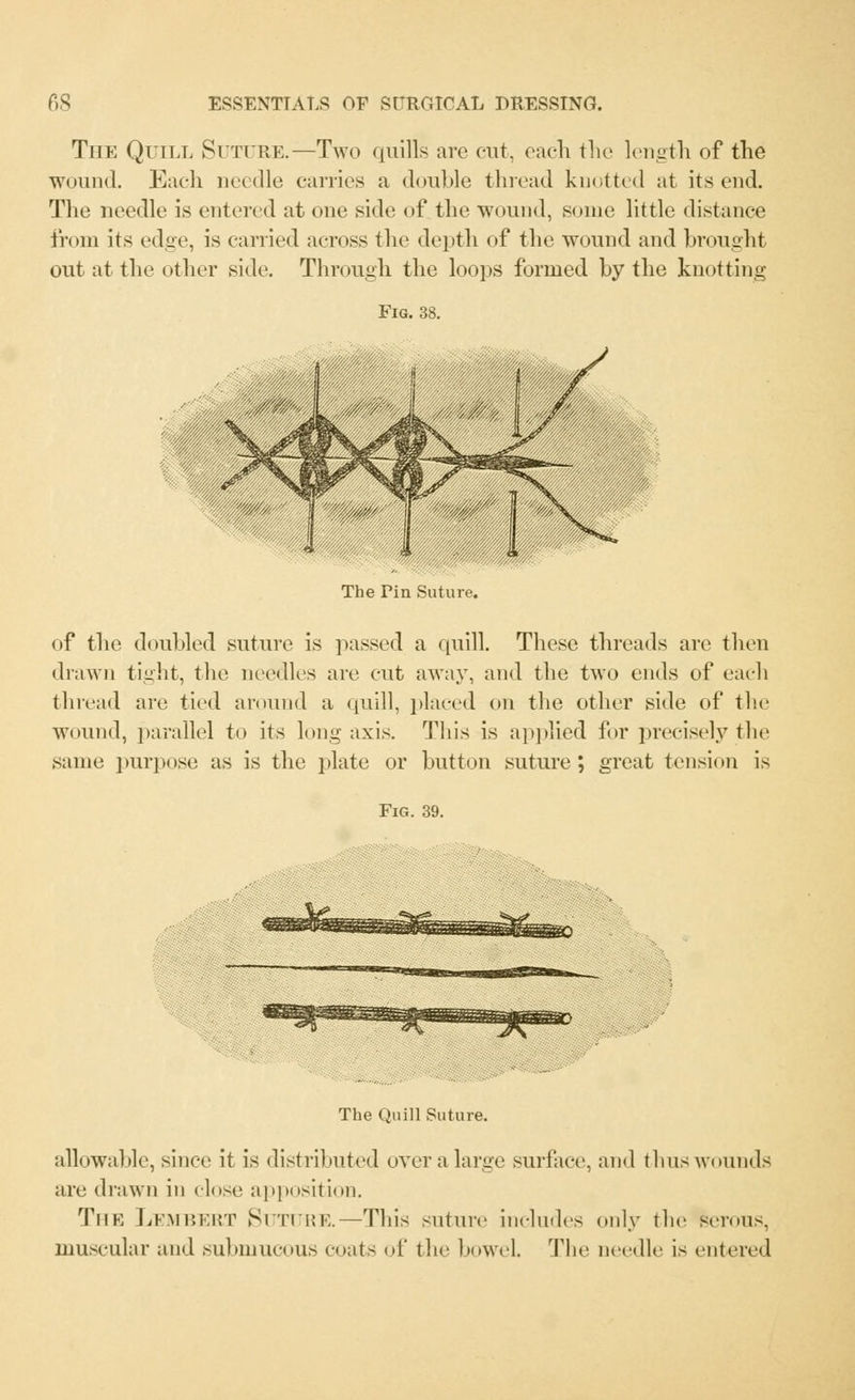 The Quill Suture.—Two quills arc cut, cadi the length of the wound. Each needle carries a double thread knotted at its end. The needle is entered at one side of the wound, some little distance from its edge, is carried across the depth of the wound and brought out at the other side. Through the loops formed by the knotting Fig. 38. The Pin Suture. of the doubled suture is passed a quill. These threads are then drawn tight, the needles arc cut away, and the two ends of cadi thread tire tied around a quill, placed on the other side of the wound, parallel to its long axis. This is applied for precisely the same purpose as is the plate or button suture; great tension is Fig. 39. The Quill Suture. allowable, since it is distributed over a large surface, and thus wounds are drawn in close apposition. The Lembert Suture.—This suture includes only the serous. muscular and submucous coats of the boweL The needle is entered