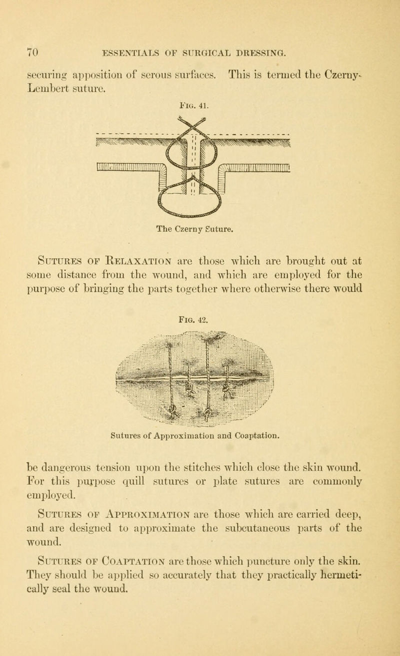 seeming apposition of serous surfaces. This is termed the Czerny- Lembert suture. Fig. 41. ■miiiifiii'ii'ii'imiHiiii' The Czerny Suture. Sutures of Relaxation are those which are brought out at some distance from the wound, and which are employed for the purpose of bringing the parts together where otherwise there would Fig. 42. * :,^F- ' Sutures of Approximation and Coaptation. be dangerous tension upon the stitches which close the skin wound. For this purpose quill sutures or plate sutures are commonly employed. Sutures of Approximation are those which are carried deep, and are designed to approximate the subcutaneous parts of the wound. Sutures of Coaptation are those which puncture only the skin. They should be applied so accurately that they practically hermeti- cally seal the wound.