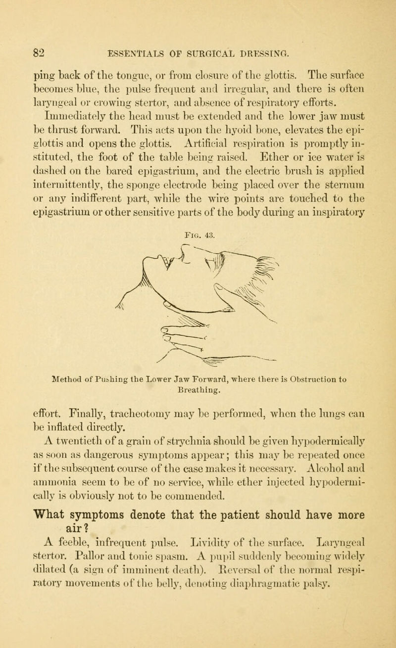 ping back of the tongue, or from closure of the glottis. The surface becomes blue, the pulse frequent and irregular, and there is often laryngeal or crowing stertor, and absence of respiratory efforts. Immediately the head must be extended and the lower jaw must be thrust forward. This acts upon the hyoid bone, elevates the epi- glottis and opens the glottis. Artificial respiration is promptly in- stituted, the foot of the table being raised. Ether or ice water is dashed on the bared epigastrium, and the electric brush is applied intermittently, the sponge electrode being placed over the sternum or any indifferent part, while the wire points are touched to the epigastrium or other sensitive parts of the body during an inspiratory Fig. 43. Method of Pushing the Lower Jaw Forward, where there is Obstruction to Breathing. effort. Finally, tracheotomy may be performed, when the lungs can be inflated directly. A twentieth of a grain of strychnia should be given hypodermically as soon as dangerous symptoms appear; this ma}7 be repeated once if the subsequent course of the case makes it necessary. Alcohol and ammonia seem to be of no service, while ether injected hypodermi- cally is obviously not to be commended. What symptoms denote that the patient should have more air? A feeble, infrequent pulse. Lividity of the surface. Laryngeal stertor. Pallor and tonic spasm. A pupil suddenly becoming widely dilated (a sign of imminent death). Reversal of the normal respi- ratory movements of the belly, denoting diaphragmatic palsy.