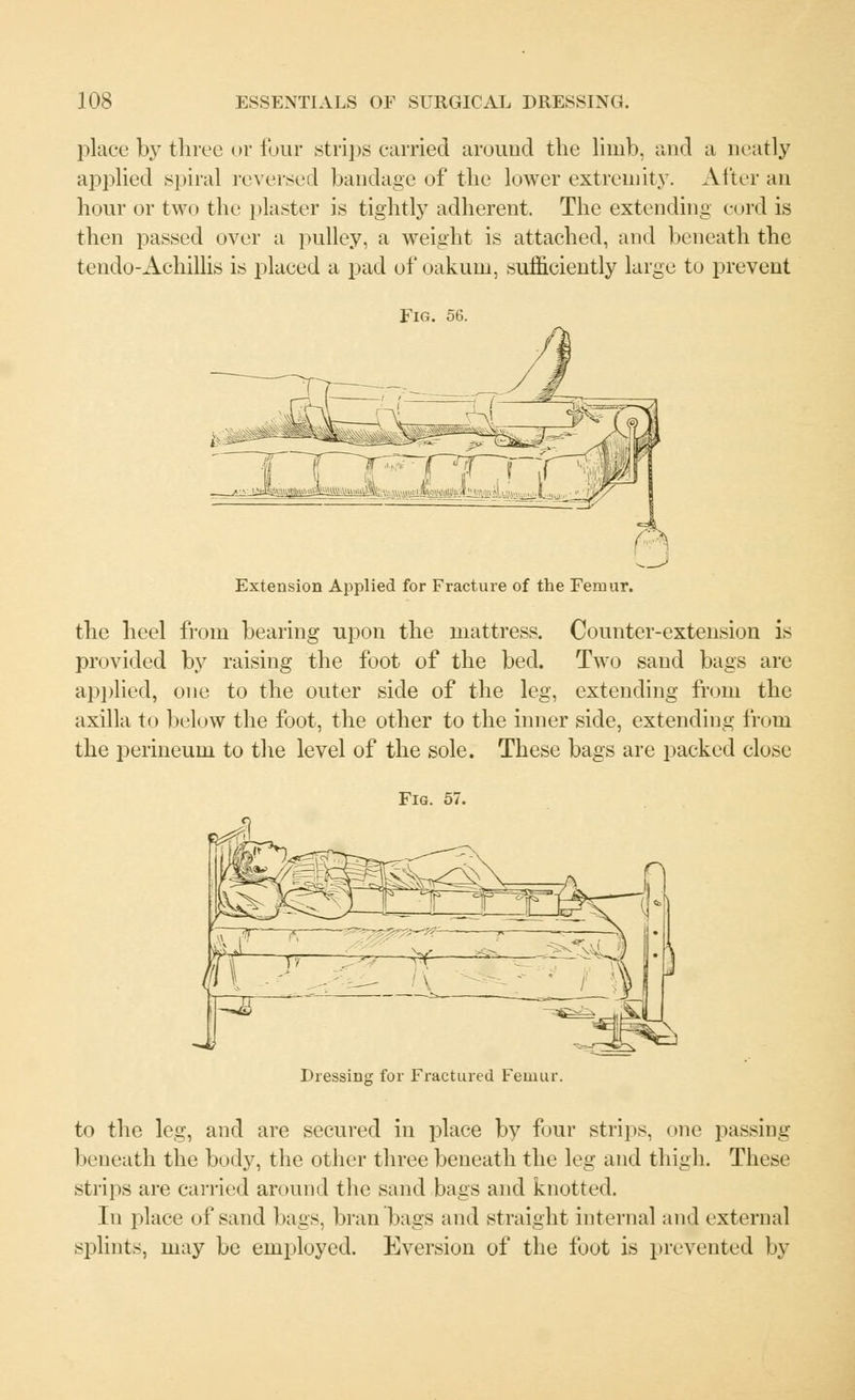 place by three or four strips carried around the limb, and a neatly applied spiral reversed bandage of the lower extremity. After an hour or two the plaster is tightly adherent. The extending cord is then passed over a pulley, a weight is attached, and beneath the tendo-Achillis is placed a pad of oakum, sufficiently large to prevent ^_J Extension Applied for Fracture of the Femur. the heel from bearing upon the mattress. Counter-extension is provided by raising the foot of the bed. Two sand bags are applied, one to the outer side of the leg, extending from the axilla to below the foot, the other to the inner side, extending from the perineum to the level of the sole. These bags are packed close Fig. 57. Dressing for Fractured Femur. to the leg, and are secured in place by four strips, one passing beneath the body, the other three beneath the leg and thigh. These strips are carried around the sand bags and knotted. In place of sand bags, bran bags and straight internal and external splints, may be employed. Eversion of the foot is prevented by
