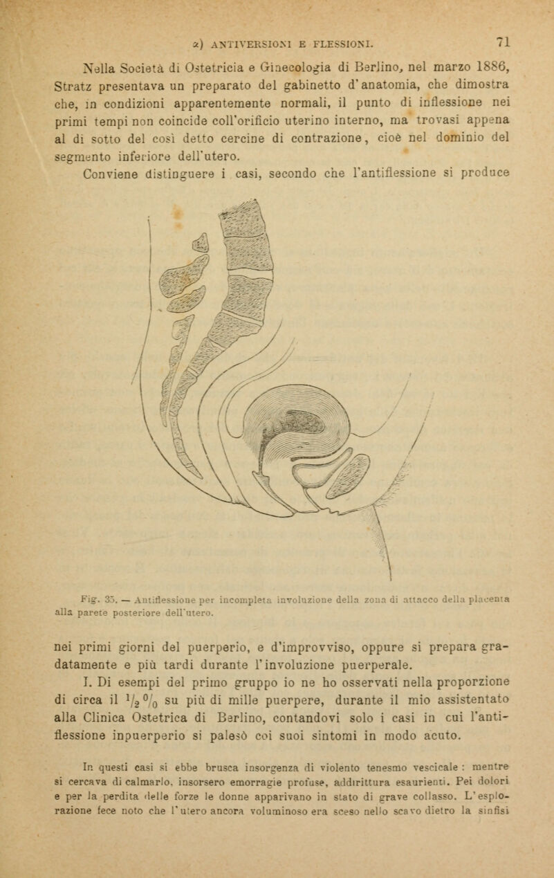 Nella Società di Ostetricia e Ginecologia di Berlino, nel marzo 1886, Stratz presentava un preparato del gabinetto d'anatomia, che dimostra che, in condizioni apparentemente normali, il punto di inflessione nei primi tempi non coincide coll'orificio uterino interno, ma trovasi appena al di sotto del così detto cercine di contrazione, cioè nel dominio del segmento inferiore dell'utero. Conviene distinguere i casi, secondo che l'antiflessione si produce Fig. 35. — Antiflessione per incompleta involuzione della zona di attacco della placenta alla parete posteriore dell'utero. nei primi giorni del puerperio, e d'improvviso, oppure si prepara gra- datamente e più tardi durante l'involuzione puerperale. I. Di esempi del primo gruppo io ne ho osservati nella proporzione di circa il V2 ° o su più di mille puerpere, durante il mio assistentato alla Clinica Ostetrica di Berlino, contandovi solo i casi in cui Tanti- flessione inpuerperio si palesò coi suoi sintomi in modo acuto. In questi casi si ebbe brusca insorgenza di violento tenesmo vescicale : mentre si cercava di calmarlo, insorsero emorragie profuse, addirittura esaurienti. Pei dolori e per la perdita delle forze le donne apparivano in stato di grave collasso. L'esplo- razione fece noto che Tuiero ancora voluminoso era sceso nello scavo dietro la sinfisi