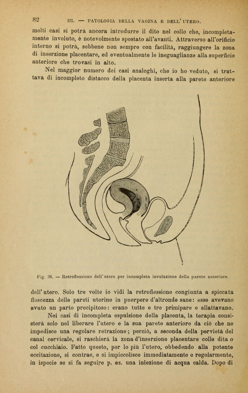 molti casi si potrà ancora introdurre il dito nel collo che, incompleta- mente involuto, è notevolmente spostato all'avanti. Attraverso all'orifìcio interno si potrà, sebbene non sempre con facilità, raggiungere la zona di inserzione placentare, ed eventualmente le ineguaglianze alla superficie anteriore che trovasi in alto. Nel maggior numero dei casi analoghi, che io ho veduto, si trat- tava di incompleto distacco della placenta inserta alla parete anteriore Fig. 38. — Retroflessione dell'utero per incompleta involuzione della parete anteriore. dell'utero. Solo tre volte io vidi la retroflessione congiunta a spiccata floscezza delle pareti uterine in puerpere d'altronde sane: esse avevano avuto un parto precipitoso: erano tutte e tre primipare e allattavano. Nei casi di incompleta espulsione della placenta, la terapia consi- sterà solo nel liberare l'utero e la sua parete anteriore da ciò che ne impedisce una regolare retrazione ; perciò, a seconda della pervietà del canal cervicale, si raschierà la zona d'inserzione placentare colle dita o col cucchiaio. Fatto questo, per lo più l'utero, obbedendo alla potente eccitazione, si contrae, e si impiccolisce immediatamente e regolarmente, in ispecie se si fa seguire p. es. una iniezione di acqua calda. Dopo di