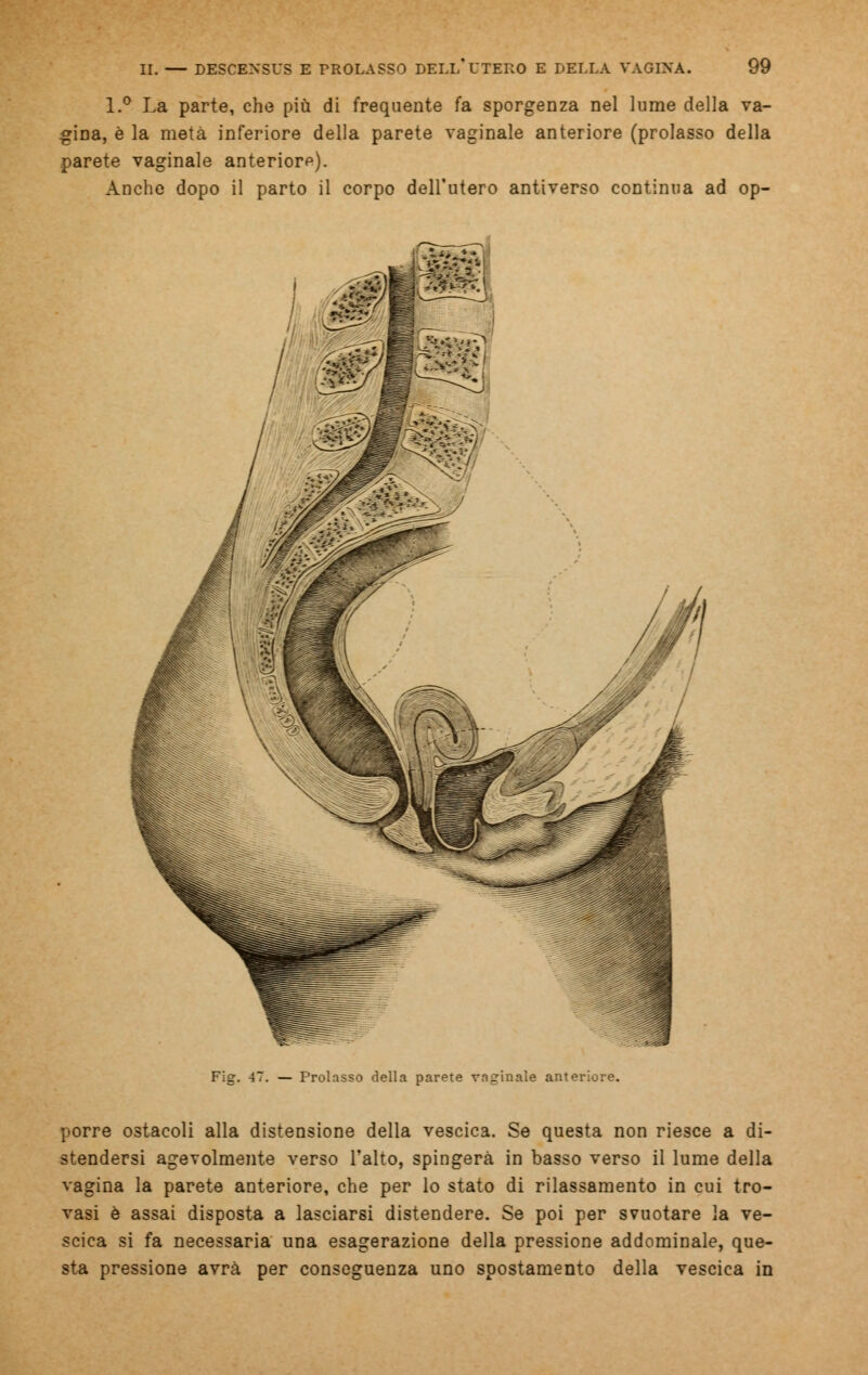 1.° La parte, che più di frequente fa sporgenza nel lume della va- gina, è la metà inferiore della parete vaginale anteriore (prolasso della parete vaginale anteriorp). Anche dopo il parto il corpo dell'utero antiverso continua ad op- Fig. 47. — Prolasso della parete vaginale anteriore. porre ostacoli alla distensione della vescica. Se questa non riesce a di- stendersi agevolmente verso l'alto, spingerà in basso verso il lume della vagina la parete anteriore, che per lo stato di rilassamento in cui tro- vasi è assai disposta a lasciarsi distendere. Se poi per svuotare la ve- scica si fa necessaria una esagerazione della pressione addominale, que- sta pressione avrà per conseguenza uno spostamento della vescica in