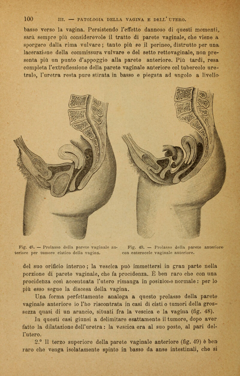 basso verso la vagina. Persistendo l'effetto dannoso di questi momenti,, sarà sempre più considerevole il tratto di parete vaginale, che viene a sporgere dalla rima vulvare ; tanto più se il perineo, distrutto per una. lacerazione della commissura vulvare e del setto rettovaginale, non pre- senta più un punto d'appoggio alla parete anteriore. Più tardi, resa completa l'extroflessione della parete vaginale anteriore col tubercolo ure- trale, l'uretra resta pure stirata in basso e piegata ad angolo a livello- Fig. 4S. — Prolasso della parete vaginale an- Fig. 49. — Prolasso della parete anteriore tenore per tumore cistico della vagina. con enterocele vaginale anteriore. del suo orifìcio interno ; la vescica può immettersi in gran parte nella porzione di parete vaginale, che fa procidenza. È ben raro che con una procidenza così accentuata l'utero rimanga in posizioi.e normale : per lo più esso segue la discesa della vagina. Una forma perfettamente analoga a questo prolasso della parete vaginale anteriore io l'ho riscontrata in casi di cisti o tumori della gros- sezza quasi di un arancio, situati fra la vescica e la vagina (fig. 48). In questi casi giunsi a delimitare esattamente il tumore, dopo aver fatto la dilatazione dell'uretra : la vescica era al suo posto, al pari del- l'utero. 2.° Il terzo superiore della parete vaginale anteriore (fig. 49) è ben raro che venga isolatamente spinto in basso da anse intestinali, che si
