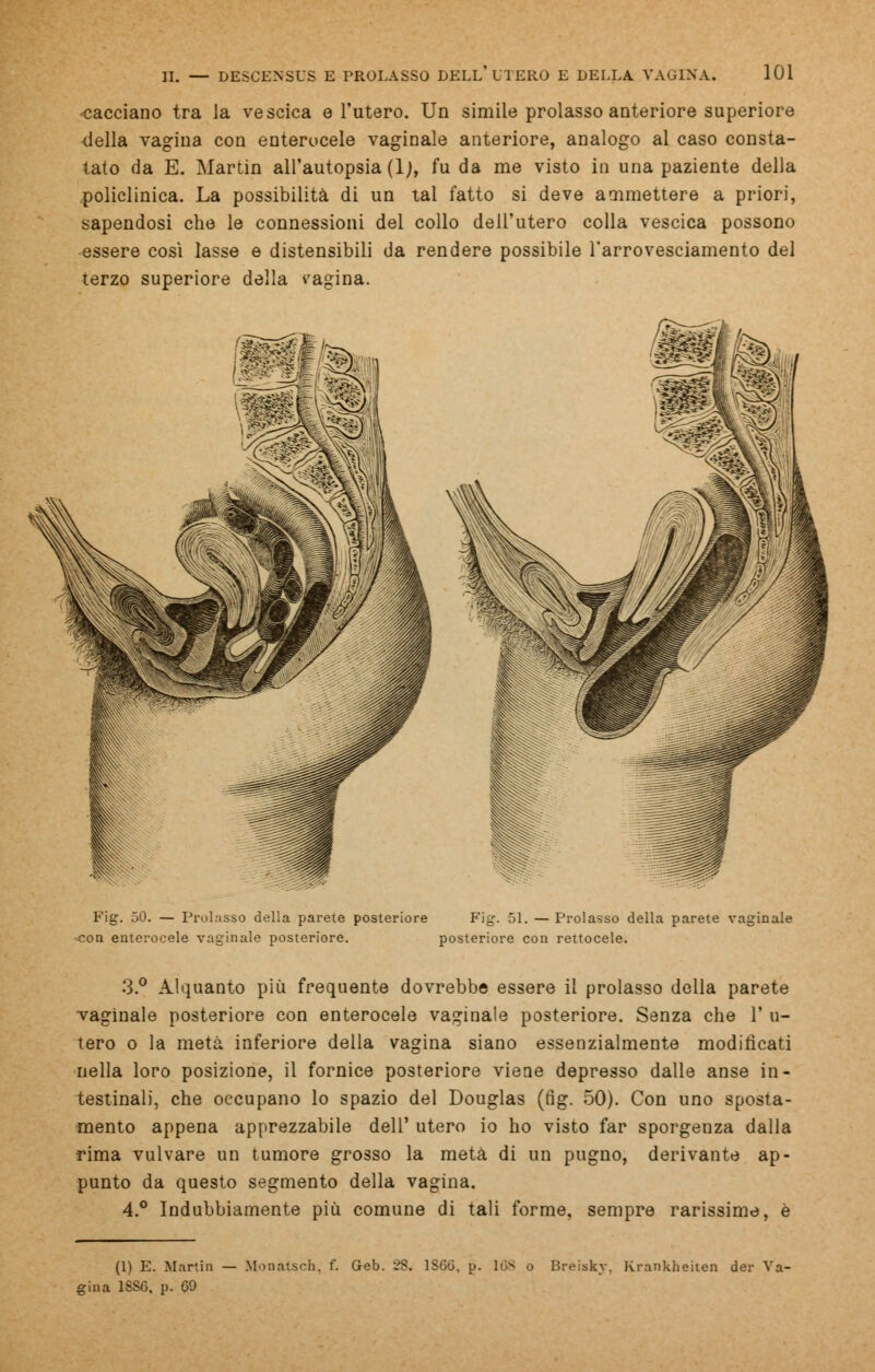 cacciano tra la vescica e l'utero. Un simile prolasso anteriore superiore della vagina con enterocele vaginale anteriore, analogo al caso consta- tato da E. Martin all'autopsia (\), fu da me visto in una paziente della policlinica. La possibilità di un tal fatto si deve ammettere a priori, sapendosi che le connessioni del collo dell'utero colla vescica possono essere così lasse e distensibili da rendere possibile l'arrovesciamento del terzo superiore della vagina. Pier. 50. — Prolasso della parete posteriore Fig. 51. — Prolasso della parete vaginale con enterocele vaginale posteriore. posteriore con rettocele. 3.° Alquanto più frequente dovrebbe essere il prolasso della parete vaginale posteriore con enterocele vaginale posteriore. Senza che 1' u- tero o la metà inferiore della vagina siano essenzialmente modificati nella loro posizione, il fornice posteriore viene depresso dalle anse in- testinali, che occupano lo spazio del Douglas (fig. 50). Con uno sposta- mento appena apprezzabile dell' utero io ho visto far sporgenza dalla rima vulvare un tumore grosso la metà di un pugno, derivante ap- punto da questo segmento della vagina. 4.° Indubbiamente più comune di tali forme, sempre rarissime, è (1) E. Martin — Monatsch. f. Geb. 28. 1S60. p. lós o Breisky, Krankheiten der Va- gina 1SS6, p. 09