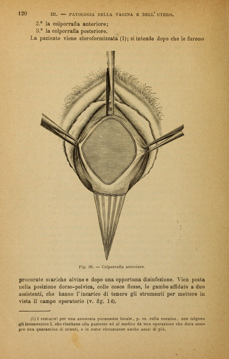 2.° la colporrafia anteriore; 3.° la colporrafia posteriore. La paziente viene cloroformizzata (1); si intende dopo che le furono 68. Colporrafia anteriore. procurate scariche alvine e dopo una opportuna disinfezione. Yien posta nella posizione dorso-pelvica, colle cosce flesse, le gambe affidate a due assistenti, che hanno l'incarico di tenere gli strumenti per mettere in vista il campo operatorio (v. fig. 14). (1) I tentativi per una anestesia puramente locale, p. es. colla cocaina, non tolgono gli inconvenien 1. che risultano alla paziente ed al medico da una operazione che dura sem- pre una quarantina di minuti, e in certe circostanze anche assai di più.