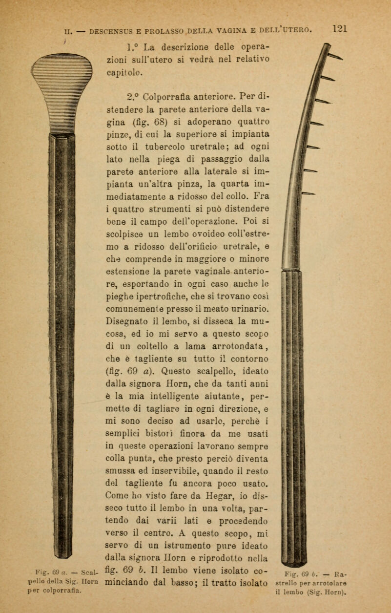 Fig. l.° La descrizione delle opera- zioni sull'utero si vedrà nel relativo capitole. 2.° Colporrafìa anteriore. Per di- stendere la parete anteriore della va- gina (fig. 68) si adoperano quattro pinze, di cui la superiore si impianta sotto il tubercolo uretrale; ad ogni lato nella piega di passaggio dalla parete anteriore alla laterale si im- pianta un'altra pinza, la quarta im- mediatamente a ridosso del collo. Fra i quattro strumenti si può distendere bene il campo dell'operazione. Poi si scolpisce un lembo ovoideo coll'estre- mo a ridosso dell'orifìcio uretrale, e che comprende in maggiore o minore estensione la parete vaginale anterio- re, esportando in ogni caso anche le pieghe ipertrofiche, che si trovano così comunemente presso il meato urinario. Disegnato il lembo, si disseca la mu- cosa, ed io mi servo a questo scopo di un coltello a lama arrotondata, che è tagliente su tutto il contorno (fig. 69 a). Questo scalpello, ideato dalla signora Horn, che da tanti anni è la mia intelligente aiutante, per- mette di tagliare in ogni direzione, e mi sono deciso ad usarle, perchè i semplici bistori finora da me usati in queste operazioni lavorano sempre colla punta, che presto perciò diventa smussa ed inservibile, quando il resto del tagliente fu ancora poco usato. Come ho visto fare da Hegar, io dis- seco tutto il lembo in una volta, par- tendo dai varii lati e procedendo verso il centro. A questo scopo, mi servo di un istrumento pure ideato dalla signora Horn e riprodotto nella fig. 69 b. Il lembo viene isolato co- Scal- pi?. 69 b. — Ra- pello della Sig. Horn minciando dal baSSO; il tratto isolato strello per arrotolare per colporrafìa. il lembo (Sig. Horn).
