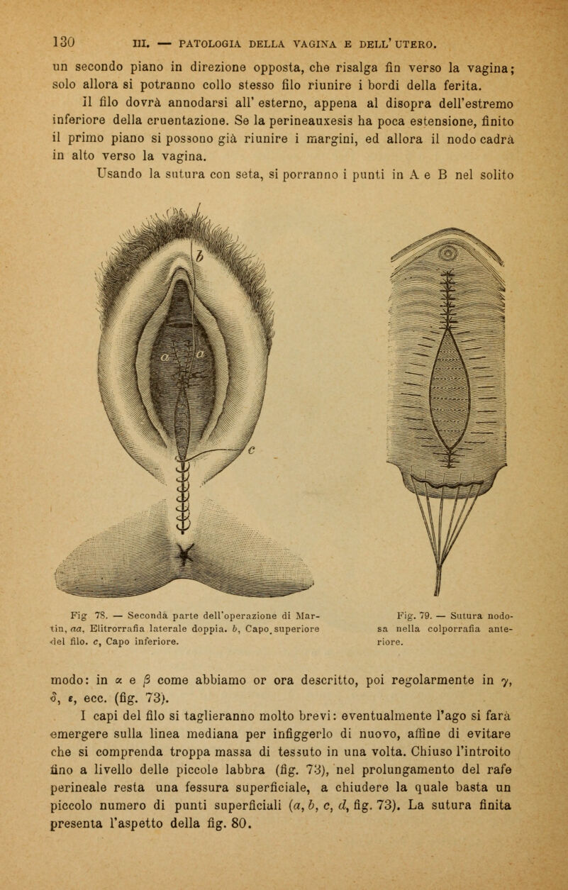 un secondo piano in direzione opposta, che risalga fin verso la vagina; solo allora si potranno collo stesso filo riunire i bordi della ferita. Il filo dovrà annodarsi all' esterno, appena al disopra dell'estremo inferiore della cruentazione. Se la perineauxesis ha poca estensione, finito il primo piano si possono già riunire i margini, ed allora il nodo cadrà in alto verso la vagina. Usando la sutura con seta, si porranno i punti in A e B nel solito Fig 78. — Seconda parte dell'operazione di Mar- tin, aa. Elitrorrafia laterale doppia, b, Capo, superiore ■del filo, e, Capo inferiore. Fig. 79. — Sutura nodo- sa nella colporrafia ante- riore. modo: in a e /3 come abbiamo or ora descritto, poi regolarmente in 7, 3, e, ecc. (fig. 73). I capi del filo si taglieranno molto brevi: eventualmente l'ago si farà emergere sulla linea mediana per infiggerlo di nuovo, affine di evitare che si comprenda troppa massa di tessuto in una volta. Chiuso l'introito fino a livello delle piccole labbra (fig. 73), nel prolungamento del rafe perineale resta una fessura superficiale, a chiudere la quale basta un piccolo numero di punti superficiali (a, b, e, J, fig. 73). La sutura finita presenta l'aspetto della fig. 80.