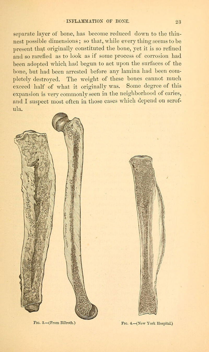 separate layer of bone, has become reduced down to the thin- nest possible dimensions; so that, while every thing seems to be present tha^t originally constituted the bone, yet it is so refined and so rarefied as to look as if some process of corrosion had been adopted which, had begun to act upon the surfaces of the bone, but had been arrested before any lamina had been com- pletely destroyed. The weight of these bones cannot much exceed half of what it originally was. Some degree of this expansion is very commonly seen in the neighborhood of caries, and I suspect most often in those cases which depend on scrof- ula. Fig. 8.—{From BUlroth.) Fig. 4.—(New Tork Hospital.)