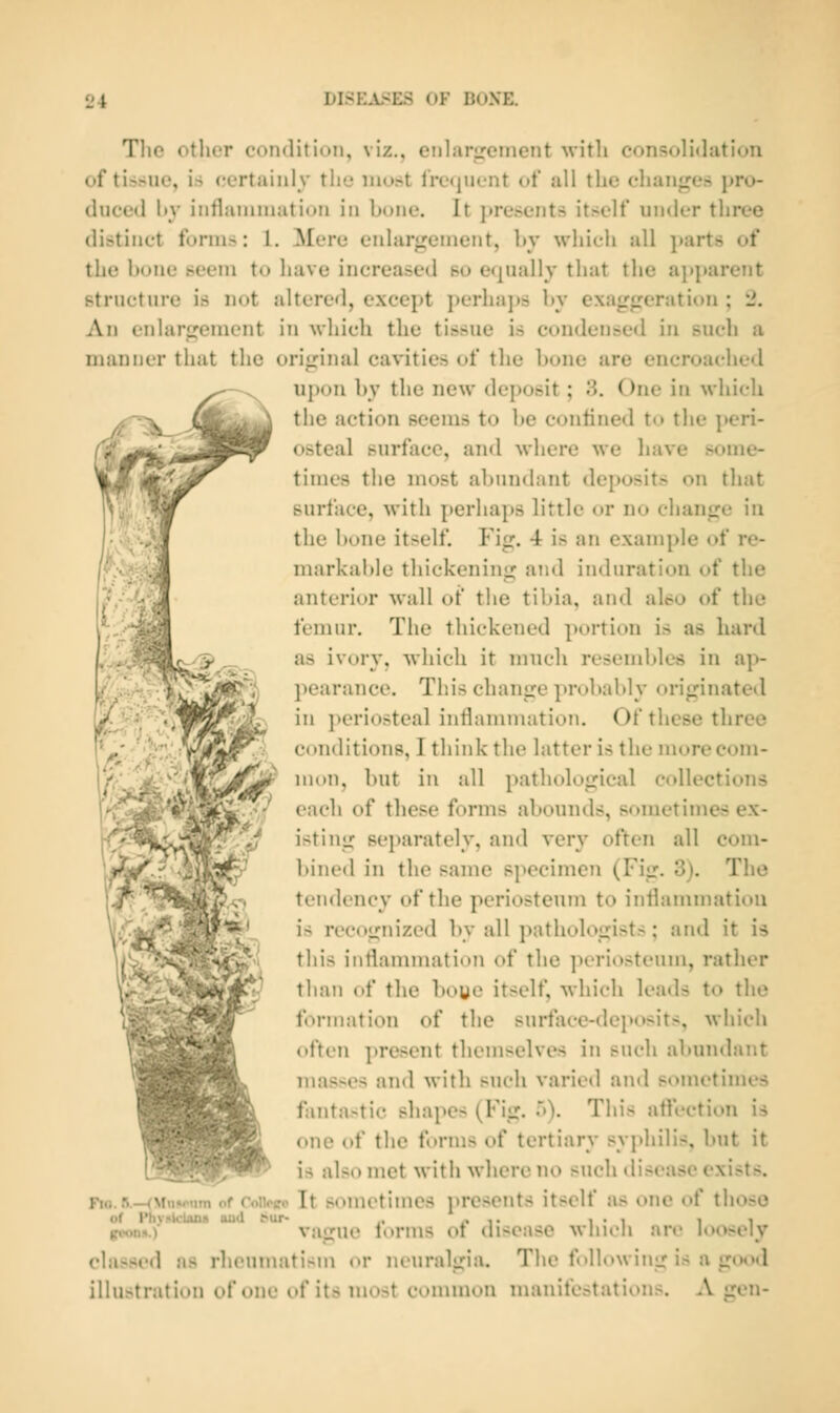 Tlic other condition, viz., eiilarfjement with consoliilation of tissue, is certainly the most fre«jnent of all the chan<res j)ro- duced hy inthininiation in bone. It jtresents itself under three distinct forms: 1. Mere enlargement, hy wiiitii all ]»art,s of the hone seem to have increased bo equally that the ajiparent structure is not altered, except j)erha]»s hy exagjreration ; 2. An enlarsjement in wliich the tissue is condensed in such a manner that the oriirinal cavities of tlie hone are encroached upon hv the new deposit; 3. One in which the action seems to be confined to the ])eri- osteal surface, and where we liave some- times the most abundant deposits on that surface, with perhaps little or no chanpre in the bone itself. Fig. 4 is an example of re- markal)le thickening and induration of the anterior Avail of the tibia, and alto of the femur. The thickened portion is as hard as ivory, which it much resenddes in ap- pearance. This change probably originated in periosteal inflammation. Of these three C(mdition8, Ithiid< the latter is the more com- mon, but in all pathological ccdlections ,';7 each of these forms abounds, sometimes ex- isting separately, and very often all com- bined in the same specimen (Fig. 3). The tendency of the periosteum to inflammation is recognized by all pathologists; and it is this inflammation of the ]H'riosteum, rather than of the boye itself, which leads to the formation of the sui*face-dei>osits, which often ])resent themselves in such abundant mas>es and with such varied and sometimes fantastic shapes (Fig. 5). This aflection is one of the f<»rms of tertiary syphilis, but it is also met with where no such disease exists. Fio. R—(Vii<w<nTn of Coiipco It somctimcs presents itself as one of those of l*hvi»kiaiiii iujU mit- ,, /» ■«• i • i i i gvtm->.) vague lorms ot disease wliieli are loosely classed as rheunnitism or neuralgia. The following is a gmxl illustration of one of its most common manifestations. A gen-