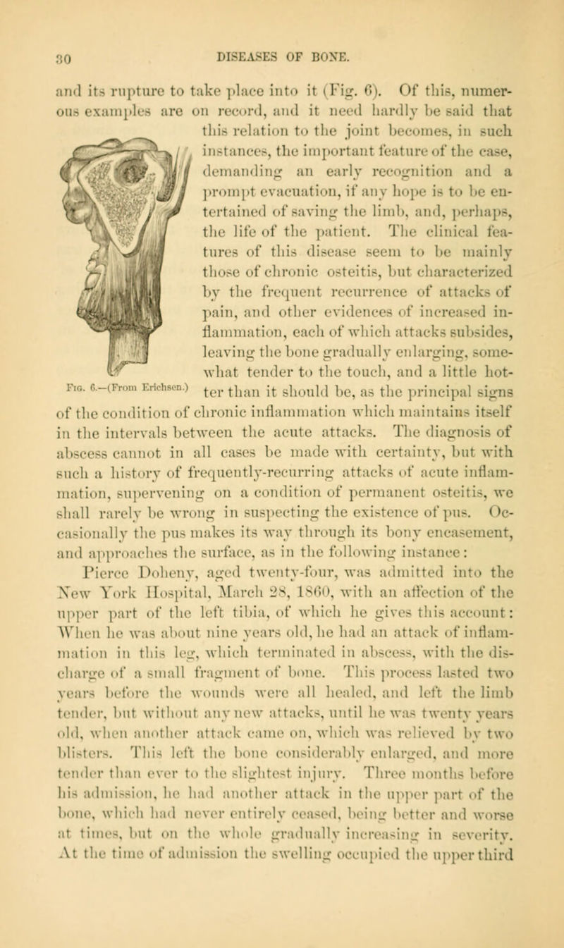 and its rupture to tuko ])laec into it (Fig. 0). Of tliis, numer- ous exaini>ks arc on rect»nl, and it need hardly be said that this rehition to the joint becomes, in such instances, the inijtortant feature of tlie case, demanding an early recognition and a prompt evacuation, if any liope is to be en- tertained of saving tlie limb, and, perhaps, the life of the patient. The clinical fea- tures of this disease seem to be mainly V those of chronic osteitis, but characterized * by the frequent recurrence of attacks of pain, and other evidences of increased in- r Hammation, each of which attacks subsides, leaving the bone gradually enlarging, some- what tender to the touch, and a little hot- no. c.-(K.-oui Erichsen.) ^^.j. ^j^.^^^ j^ sliould be, as tlic principal signs of the condition of chronic inflammation which maintains itself in the intervals between the acute attacks. The diagnosis of abscess cannot in all cases be made with certainty, but with Fucli a liistorv of frequently-recurring attacks of acute inflam- mation, sni)ervcning on a condition of permanent osteitis, we sliall rarely l)e wrong in suspecting the existence of pus. Oc- casionally the pus nnikes its way through its bony encasement, and approaches the surfiice, as in the following instance: Pierce Doheny, aged twenty-four, was admitted into the Xew York Ilosjiital, ^Lirch 2S, 1S«)(), -with an aflection of the upper part of the left tibia, of which he gives this account: AVhen he was about nine years old, he had an attack of inflam- mation in this leg, which terminated in abscess, with the dis- charge of a small fragment of bone. This process histed two years before the wounds Mere all liealed, and left the limb tender, but witliiuit any new attacks, until he wa.s twenty years old, when another attack came on, which was relieved by two blisters. This left the bone considerably enlarged, and more teiidiT tliMii ever 1o tlie slightest injury. Three months before his admission, he had another attack in the ti]>]>i'r part of the bone, which had never entirely ceased, being better and worse at times, but on tlii' whole gradually inereasimx in severity. .\t the time of aiimission the swelling occupied the upper third