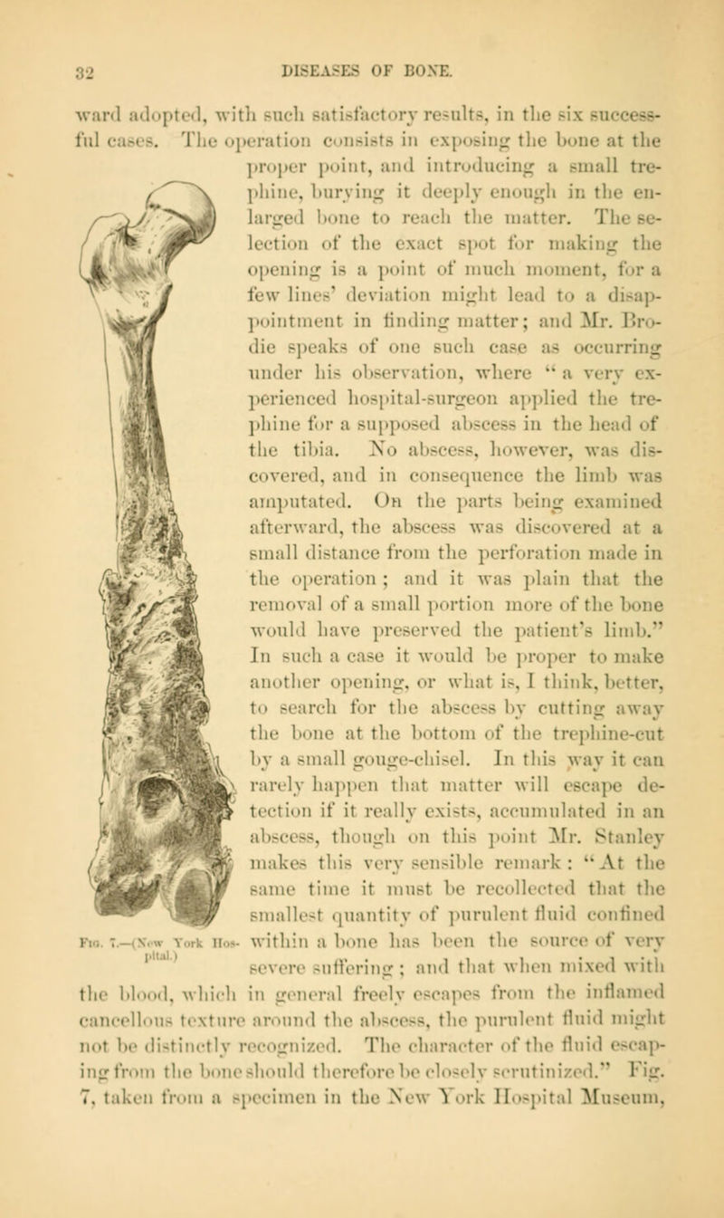 •ward adn[)to<l, whh such satisfactory results, in the six success- ful cases. Tlie oi>cratioii consists in cx[)o&in^ the bone at the proper point, and introducing a small tre- phine, l)urvin<^ it dccj)ly encjugh in the en- large<l hone to reacli the matter. The se- lection of the exact spot for making the opening is a })oint of niucli moment, for a few lines' deviation miglit lead to a disap- pointment in finding matter; and Mr. Bro- die speaks of one such case as occurring under his observation, where  a very ex- perienced liospital-snrgeon applied the tre- jihine for a supposed abscess in the head of the tibia. Ko abscess, however, was dis- covered, and in consequence the lindj was amputated. On the parts being examined afterward, the abscess was discovered at a small distance from the perforation made in the oi»eration ; and it was plain that the removal of a small portion more of the bone would have preserved the patient's limb. In such a case it would be ]»roper to make another opening, or what is, I think, better, to search for the abscess by cutting away the bone at the bottom of the trephine-cut by a small gouge-chisel. In this way it can rarely ha])pen that matter will escape de- tection if it really exists, accumulated in an abscess, though on this point Mr. Stanley makes this very sensible remark :  At the same time it must be recollected that the smallest quantity of jnirulent flui<l confined within a bono has been the source of very severe sufferimx ; and that when mixed with the lilood, Mbicli in general freely escapes from tlie inflamed cancellous textnre anMuid the abscess, the pm-ulcnt fluid might not be distinctly nvognized. The character of the flnid escap- ingfrom the bone should therefore bo closely scrutinized.'' Fig. 7, taken from a specimen in the New York Hospital Museum, Fio. .—(Nt'W York Ho* j.ltal.)