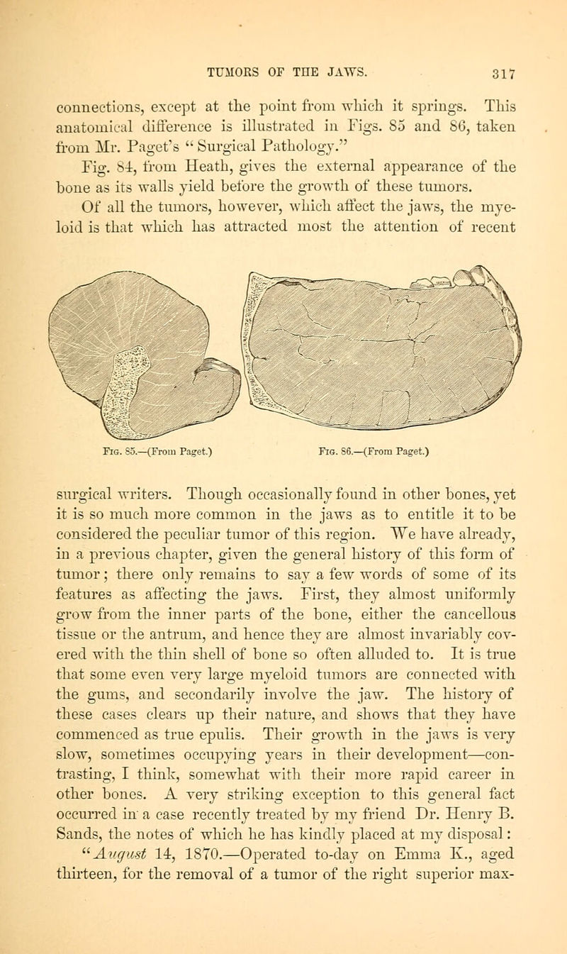 connections, except at the point from which it s^Drings. This anatomical difference is illustrated in Figs. 85 and 86, taken from Mr. Paget's Surgical Pathology. Fig. 84, from Heath, gives the external appearance of the bone as its walls yield before the growth of these tumors. Of all the tumors, however, which aifect the jaws, the mye- loid is that w^hich has attracted most the attention of recent Fig. 85.—(From Paget.) Fig. 86.—(From Paget.) surgical writers. Though occasionally found in other bones, yet it is so much more common in the jaws as to entitle it to be considered the peculiar tumor of this region. We have already, in a previous chapter, given the general history of this foiTn of tumor; there only remains to say a few words of some of its features as affecting the jaws. First, they almost unifonnly grow from the inner parts of the bone, either the cancellous tissue or the antrum, and hence they are almost invariably cov- ered with the thin shell of bone so often alluded to. It is true that some even very large myeloid tumors are connected with the gums, and secondarily involve the jaw. The histoiy of these cases clears up their nature, and shows that they have commenced as true epulis. Their growth in the jaws is very slow, sometimes occupying years in their development—con- trasting, I think, somewhat with their more rapid career in other bones. A very striking exception to this general fact occuiTed in' a case recently treated by my friend Dr. Henry B. Sands, the notes of which he has kindly placed at my disposal: ^^ August 14, 1870.—Operated to-day on Emma K., aged thirteen, for the removal of a tumor of the right superior max-