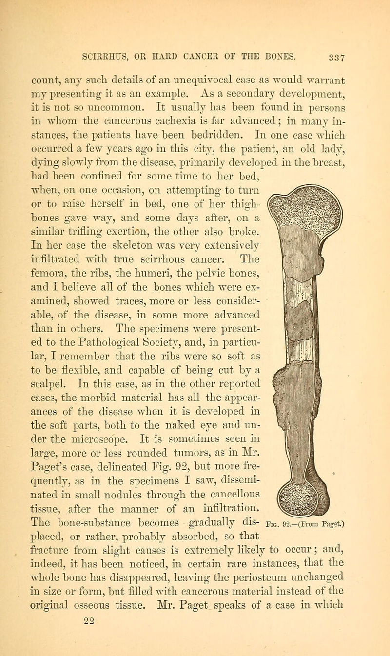 count, any such details of an unequivocal case as would warrant my presenting it as an example. As a secondary development, it is not so uncommon. It usually lias been found in persons in whom the cancerous cachexia is far advanced; in man}^ in- stances, the patients have been bedridden. In one case which occurred a few years ago in this city, the patient, an old lady, dying slowly from the disease, primarily developed in the breast, had been confined for some time to her bed, when, on one occasion, on attempting to turn or to raise herself in bed, one of her thigh- bones gave way, and some days after, on a similar trifling exertion, the other also broke. In her case the skeleton was very extensively infiltrated with true scirrhous cancer. The femora, the ribs, the humeri, the pelvic bones, and I believe all of the bones which were ex- amined, showed traces, more or less consider- able, of the disease, in some more advanced than in others. The specimens were present- ed to the Pathological Society, and, in particu- lar, I remember that the ribs were so soft as to be flexible, and capable of being cut by a scalpel. In this case, as in the other reported cases, the morbid material has all the appear- ances of the disease when it is developed in the soft parts, both to the naked eye and un- der the microscope. It is sometimes seen in large, more or less rounded tumors, as in Mr. Paget's case, delineated Fig. 92, but more fre- cpiently, as in the specimens I saw, dissemi- nated in small nodules through the cancellous tissue, after the manner of an infiltration. The bone-substance becomes gradually dis- fk}. 92.-(From Paget.) placed, or rather, probably absorbed, so that fracture from slight causes is extremely likely to occur; and, indeed, it has been noticed, in certain rare instances, that the whole bone has disappeared, leaving the periosteum unchanged in size or form, but filled with cancerous material instead of the original osseous tissue. Mr. Paget speaks of a case in which 22