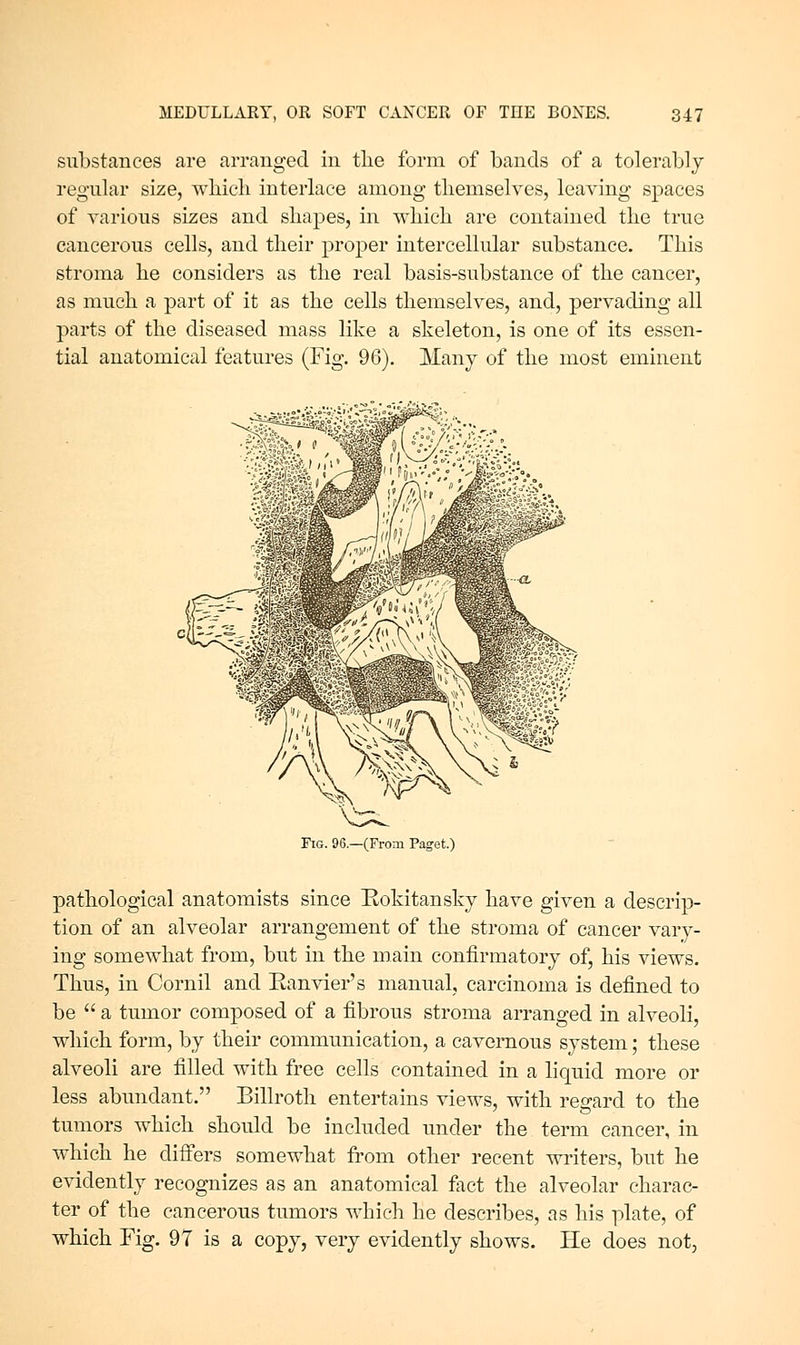 substances are arranged in the form of bands of a tolerably regular size, wliieli interlace among themselves, leaving spaces of various sizes and shapes, in which are contained the true cancerous cells, and their proper intercellular substance. This stroma he considers as the real basis-substance of the cancer, as much a part of it as the cells themselves, and, pervading all parts of the diseased mass like a skeleton, is one of its essen- tial anatomical features (Fig. 96). Many of the most eminent Fig. 96—(From Paget.) pathological anatomists since Rokitansky have given a descrip- tion of an alveolar arrangement of the stroma of cancer vary- ing somewhat from, but in the main confirmatory of, his views. Thus, in Cornil and Eanvier's manual, carcinoma is defined to be  a tumor composed of a fibrous stroma arranged in alveoli, which form, by their communication, a cavernous system; these alveoli are filled with free cells contained in a liquid more or less abundant. Billroth entertains views, with regard to the tumors which should be included under the term cancer, in which he differs somewhat from other recent writers, but he evidently recognizes as an anatomical fact the alveolar charac- ter of the cancerous tumors which he describes, as his plate, of which Fig. 97 is a copy, very evidently shows. He does not,