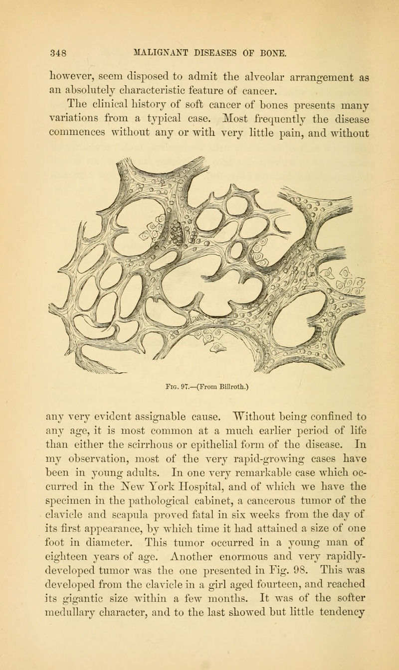 however, seem disposed to admit tlie alveolar arrangement as an absolutely characteristic feature of cancer. The clinical history of soft cancer of bones presents many variations from a tjq^ical case. Most frequently the disease commences without any or with very little pain, and without Fig. 97.—(From Billrotli.) any very evident assignable cause. Without being confined to any age, it is most common at a much earlier period of life than either the scirrhous or epithelial form of the disease. In my observation, most of the very rapid-growing cases have been in young adults. In one very remarkable case which oc- curred in the Kew York Hospital, and of which we have the specimen in the pathological cabinet, a cancerous tumor of the clavicle and scapula proved fatal in six weeks from the day of its first appearance, by which time it had attained a size of one foot in diameter. This tumor occurred in a young man of eighteen years of age. Another enormous and very rapidly- developed tumor was the one presented in Fig. 98. This was developed from the clavicle in a girl aged fourteen, and reached its gigantic size within a few months. It was of the softer medullary character, and to the last showed but little tendency