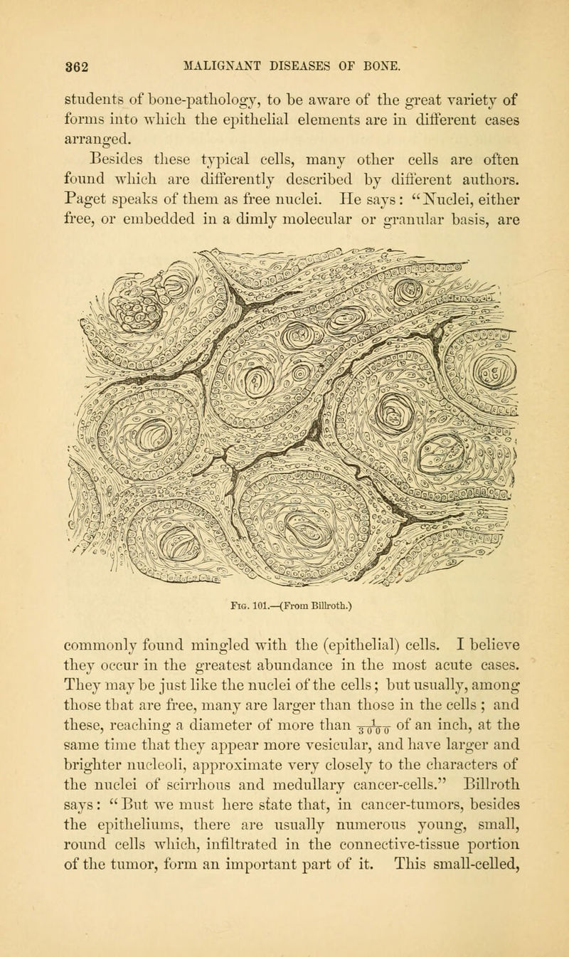 students of boiie-patliology, to be aware of tlie great variety of forms into wliicli the epithelial elements are in diiferent cases arranged. Besides these typical cells, many other cells are often found which are differently described by different authors. Paget speaks of them as free nuclei. He says : Nuclei, either free, or embedded in a dimly molecular or granular basis, are Fig. 101.—(From Billroth.) commonly found mingled with the (epithelial) cells. I believe they occur in the greatest abundance in the most acute cases. They may be just like the nuclei of the cells; but usually, among those that are free, many are larger than thosa in the cells ; and these, reaching a diameter of more than 3-0^ q- of an inch, at the same time that they appear more vesicular, and have larger and brighter nucleoli, approximate very closely to the characters of the nuclei of scirrhous and medullary cancer-cells. Billroth says: But we must here state that, in cancer-tumors, besides the epitheliums, there are usually numerous young, small, round cells which, infiltrated in the connective-tissue portion of the tumor, form an important part of it. This small-celled,