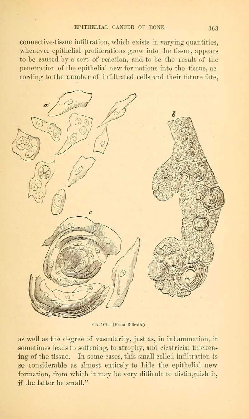 3C3 connective-tissue infiltration, wliieli exists in varying quantities, whenever epithelial proliferations grow into the tissue, appears to be caused by a sort of reaction, and to be the result of the penetration of the epithelial ne^^ formations into the tissue, ac- cording to the number of infiltrated cells and their future late. Fig. 102.—(From BiUrotli.) as well as the degree of vascularity, just as, in inflammation, it sometimes leads to softening, to atrophy, and cicatricial thicken- ing of the tissue. In some cases, this small-celled infiltration is so considerable as almost entirely to hide the epithelial new formation, from which it may be very difficult to distinguish it, if the latter be small.