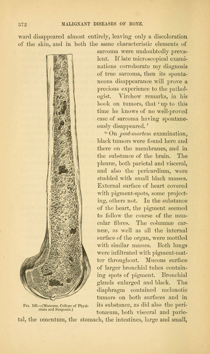 ward disappeared almost entirely, leaving only a discoloration of the skin, and in both the same characteristic elements of sarcoma were undoubtedly preva- lent. If late microscopical exami- nations corroborate my diagnosis of true sarcoma, then its sponta- neous disappearance will prove a precious experience to the pathol- ogist. Yirchow remarks, in his book on tumors, that ' up to this time he knows of no well-proved case of sarcoma having spontane- ously disappeared.' '* On post-mortem examination, black tumors were found here and there on the membranes, and in the substance of the brain. The pleursB, both parietal and visceral, and also the pericardium, were studded with small black masses. External surface of heart covered with pigment-spots, some project- ing, others not. In the substance of the heart, the pigment seemed to follow the course of the mus- cular iibres. The columnse car- nece, as well as all the internal surface of the organ, were mottled with similar masses. Both lungs were infiltrated with pigment-mat- ter throughout. Mucous surface of larger bronchial tubes contain- ing spots of pigment. Bronchial glands enlarged and black. The diaphragm contained melanotic tumors on both surfaces and in Pig. 103.—(Museum, College of Physi- its substaucc, as did also the peri- cians and Surgeons.) . t i i • i i tonceum, both visceral and parie- tal, the omentum, the stomach, the intestines, large and small,