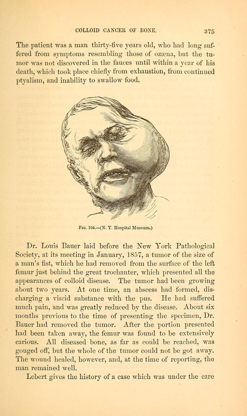 The patient was a man thirty-five years old, who had long suf- fered from symptoms resembling those of ozania, but the tu- mor was not discovered in the fauces until within a year of his death, which took place chiefly from exhaustion, from continued ptyalism, and inability to swallow food. Fig. 104.—(N. T. Hospital Museum.) Dr. Louis Bauer laid before the New York Pathological Society, at its meeting in January, 185T, a tumor of the size of a man's fist, which he had removed fi'om the surface of the left femur just behind the great trochanter, which presented all the appearances of colloid disease. The tumor had been growing about two years. At one time, an abscess had formed, dis- charging a viscid substance with the pus. He had suffered much pain, iand was greatly reduced by the disease. About six months previous to the time of presenting the specimen, Dr. Bauer had removed the tumor. After the portion presented had been taken away, the femur was found to be extensively carious. All diseased bone, as far as could be reached, was gouged off, but the whole of the tumor could not be got away. The wound healed, however, and, at the time of reporting, the man remained well. Lebert gives the history of a case which was under the care