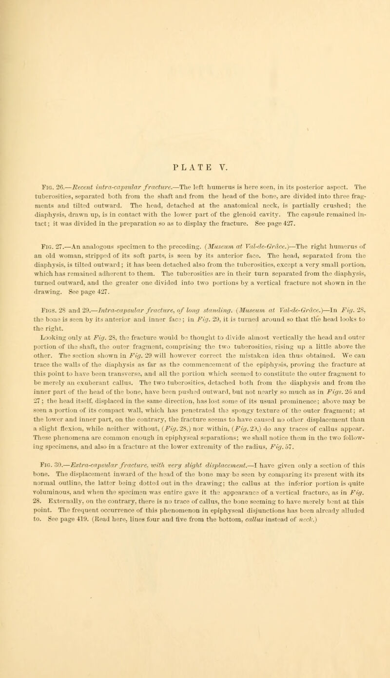 Fig. 26.— It'ni id intra-capsidar fracture.—The left humerus is here seen, in its posterior aspect. The tuberosities, separated both from the shaft and from the head of the bone, are divided into three frag- ments and tilted outward. The head, detached at the anatomical neck, is partially crushed; the diaphysis, drawn up, is in contact with the lower part of the glenoid cavity. The capsule remained in- tact : it was divided in the preparation so a.s to display the fracture. See page 427. Pig. 27.—An analogous specimen to the preceding, i Museum at Valrde-Gr&ce.)—The right humerus of an old woman, stripped of its soft parts, is seen by its anterior face. The head, separated from the diaphysis, is tilted outward; it has been detached also from the tuberosities, except a very small portion, which has remained adherent to them. The tuberosities are in their turn separated from the diaphysis, turned outward, and the greater one divided into two portions by a vertical fracture not shown in the drawing. See page 427. I [68.28 and 29.—Intra-capsular fracture, of long standing. (Museum at Valrde-Grdce.)—In Fig.28, the bone is seen by its anterior and inner face; in Fig. 29, it is turned around so that the head looks to the right. Looking only at Fig. 28, the fracture would hi thought to divide almost vertically the head and outer portion <if the shaft, the outer fragment, comprising the two tuberosities, rising up a little above the other. The section shown in Fig. 29 will however correct the mistaken idea thus obtained. We can trace the walls of the diaphysis as far as the commencement of the epiphysis, proving the fracture at this point to have been transverse, and all the portion which seemed to constitute the outer fragment to be merely an exuberant callus. The two tuberosities, detached both from the diaphysis and from the inner part of the head of the bone, have been pushed outward, but not nearly so much as in Figs. 26 and 27 ; the head itself, displaced in the same direction, has lost some of its usual prominence; above may be seen a portion of its compact wall, which lias penetrated the spongy texture of the outer fragment; at the lower and inner part, on the contrary, the fracture seems to have caused no other displacement than a slight flexion, while neither without, (Fig.28,) nor within, (Fig.'!'),) do any traces of callus appear. These phenomena are common enough in epiphyseal separations; we shall notice them in the two follow- ing specimens, and also in a fracture at the lower extremity of the radius. Fig. 57. Fig. 30.—Extra-capstdar fracture, with very slight displacement.—I have given only a section of this bone. The displacement inward of the head of the bone may be seen by comparing its present with its normal outline, the latter being dotted out in the drawing; the callus at the inferior portion is quite voluminous, and when the specimen was entire gave it the appearance of a vertical fracture, as in Fig. 28. Externally, on the contrary, there is no trace of callus, the bone seeming to have merely b snt at this point. The frequent occurrence of this phenomenon in epiphyseal disjunctions has been already alluded to. See page 419. (Read here, lines four and Ave from the bottom, callus instead of neck.)