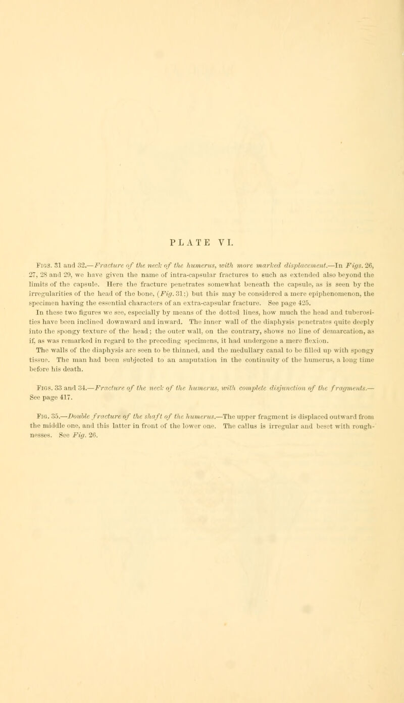 Fir.s. SI and 32.— Fracture of the neck of the humerus, with mure marked displaa tm /''.—In Figs. 26, 27, 28 and 29, we have given the name of intra-capsular fractures to such as extended also beyond the limits of the capsule. 11 <• i-<■ tit-- fracture p'-m-tr:itt>s somewhat beneath tin1 capsule, as is Been by the ularities of the head of the bone, i Fig. 31; | but this may be considered a mere epiphenomenon, the specimen having the essentia] characters of an extra-capsular fracture. See page 426. In these t\v<> figures \n: see, especially by means of the dotted lines, bow much the bend and tuberosi- ties have been inclined downward and inward. The inner wall of the diaphysb quite deeph into the spongy texture of the bead: the outer wall, on the contrary, shows no line of demarcation, as if. a~ was remarked in regard to the preceding specimens, it bail undergone a re flexion. The walls of the diaphysis are seen to be thinned, and the medullary canal to be filled up with ap ti-.-ue. The man had been subjected to an amputation in the continuity of the humerus, a long time I »fore his death. Pi08. 33 and 34.—Fracture of the necl of the humerus, with complete disjunction of Vie fragn See page 417. E s. 35.— Double fracture of the shaft of thi humerus.—The upper fragment is displaced outward from the middle one, and this latter in front of the lower one. The callus is irregular and beset with rough- nesses. See Fig. 26.