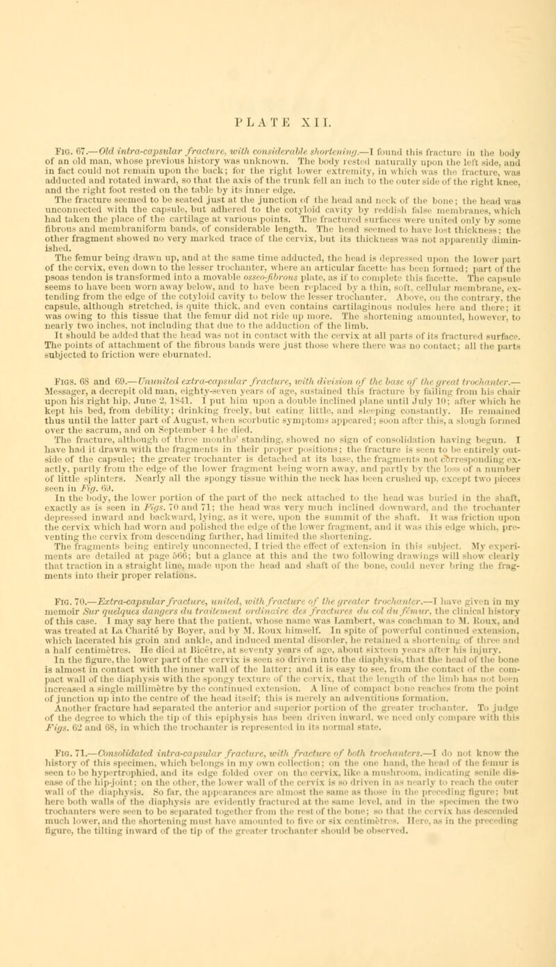 Fio. 67.—Old intracapsular fracture, villi considerable shortening.—] found tliis fracture in the body of an old man. whoso previous history was unknown. The body rested naturally upon th in fact could not remain upon the back; foi the right lower extremity, in which wa adducted and rotated Inward, 80 that the a\is of the trunk fell an inch iii tl uter side of i ho i ight and the right foot rested on the table by its inner edge. The fracture seemed to be Beated just at the junction of the head and aecl ol the I ; tie I unconnected with tlie capsule, but adhered to the cotyloid cavitj bj reddi !i false membranes, which bad taki a the place of the cartilage at various points. The fractui d surfaci were united onlj I • fibrous and inemhianil'..mi bauds, of com iderable Length. The bead seemed to have Lost thickness; tie- other fragment showed no very marked trace of the cervix, but its thickness was not ftppari ntlj dimin- ished. The femnr being drawn up, and at tiie same time adducted, the head is depressed upon the Lower part of the cervix, even down to the lesser t roe hauler, where an articular facette has been formed; part of the psoas tendon is transformed into a movable osseo-fibrous plate, as if to complete this facette. The capsule seems to have been worn awaj below, and to have been replaced bj a thin, soft cellular membrane, ex- tending from thi edge of the cotyloid cavity to below the lesser trochanter. Above, on the contrary, the capsule, although stretched, is quite thick, and even contains cartilaginous nodules here and thei was owing to this tissue thai the femur did not ride up more. The shortening amounted, howevi i nearly two inches, not including that due to the adduction Of the Limb. it should be added thai the lead was not in contact with the cervix at all parts of its fractnn d Burface. The points of attachment of the til nous hands were just those where there wa 9 no contact; all the parte subjected to friction were eburnated. Figs. 68 and 69.—Ununited extra-capsular fracture, with division oj tin bas< of (hi great trochanter.— Blessager, a decrepit old man. eighty-si vi n year: of age, sustained this fracture by falling from his chair upon iiis right hip, June 2, 1841, i pUf him upon a double inclined plane until July 10; after which he kept bis bed, from debility; drinking freely, but eating little, and sleeping constantly. He remained thus until the latter part of August, when scorbutic symptoms appeared; soon afb r this, a -I mgh formed over the sacrum, and on September 4 he died. The fracture, although of thi e month standing showed no sign of consolidation having begun. I have had it drawn with the fragments in their proper positions; the fracture is Been to be entirely out- side of the capsule; the greater trochanter is detached at its base, the fragments not correspondin actly, partly from the edge of the lower fragment being worn awa of a number ol little iii iii rs. Nearly all the spongy tissue within the in cU has been 1 rushed up, except two pieo - seen in Fiij. 69. In the body, the lower portion of the part of the neck attached to the head was buried in tie- exactly as is seen in Figs. 70 and 71; the head wai very much inclined downward, and the trochanter depressed inward and backward, lying, as it were, upon the summit of the Bhaft. it was friction upon tie- cervix which had worn and polished the edge of tie- lower fragment, audit which, pre- venting the cervix from descending farther, had limited th ening. The fragments being entirely unconnected, I tried the efifi to) tension in this subject. My experi- ments are detailed butaglance at this and the two following drawings will show clearlj that tract ion in a straight line, made upon the head and Bhaft of the bone, could never bring thi ments into their proper relation-. Fig.70.—Extra-capsular fracture, united, with fractur of the greater trochanter.—1 have given in my memoir Sur quelques dangers du traitemeni ordinaire des fractures du • of this case. 1 may say hen- that the patient, whose name was Lambert, was coachman to M. Roux, and was treated at La Charite by Boyer, and by M. Roux himself, in spite of powerful continued extension, which lacerated his groin and ankle, and induced mental disorder, he retained a shortening of th - a half centimetres. He died at Bicetre, at Beventj years of age, about sixteen years after his injury. In the figure, the lower part of the cervix is Been so driven into the diaphj -i-. that the head ol the bone is almost in contact with the inner wall of the latter: and it i> easj to bi e, from the contact of the e - pa.t wall of the diaphy sis with the -p >ngj texture of the cervix, that the Length of tfa increased a single millimetre bj the continued extension. A line of compact b in ■ reaches from the point of junction up into the centre of the head itself; this is m irelj an adventitious for tion. Vnother fracture had separated the anterioi and ■' n of the greater trochanter. T of the degree to which the tip of thi- epiphysis has been driven inward, we 1 only compare with this Tigs. 62 and 68, in which the trochanter is represented in it- normal Fig. 71.—Consolidated intra-capsular fracture, with fracturt of both trochanters.—1 do not know the hist 1 j of thi- specimen, which belonf - in mj ow a • Election; on the one hand, the hi ad of the femur i> —n to be hypertrophied, and its edge folded ovei on the cervix, like a mushroom, indicating senile ease of the hip-joint; on the other, the Lowi r wall of the o ryis i- so driven in a< nearly to reach thi wall of the diaphysis. So tar. tie a] p dmost the same as those in the pi bul here both walls of the diaphysis are evidently fracl tired at the - ime Level, and In the specimen the two inters were Been to be separated togi th 1 B the n si ot the bone; bo that the a n 1 \ has descended much lower, a ml tie- shortening must ha v.- amounted to t i %. - or -i\ centimetres. Her . as in the- preceding figure, tin- tilting inward of the tip of the greater trochanter should 1 bserved.
