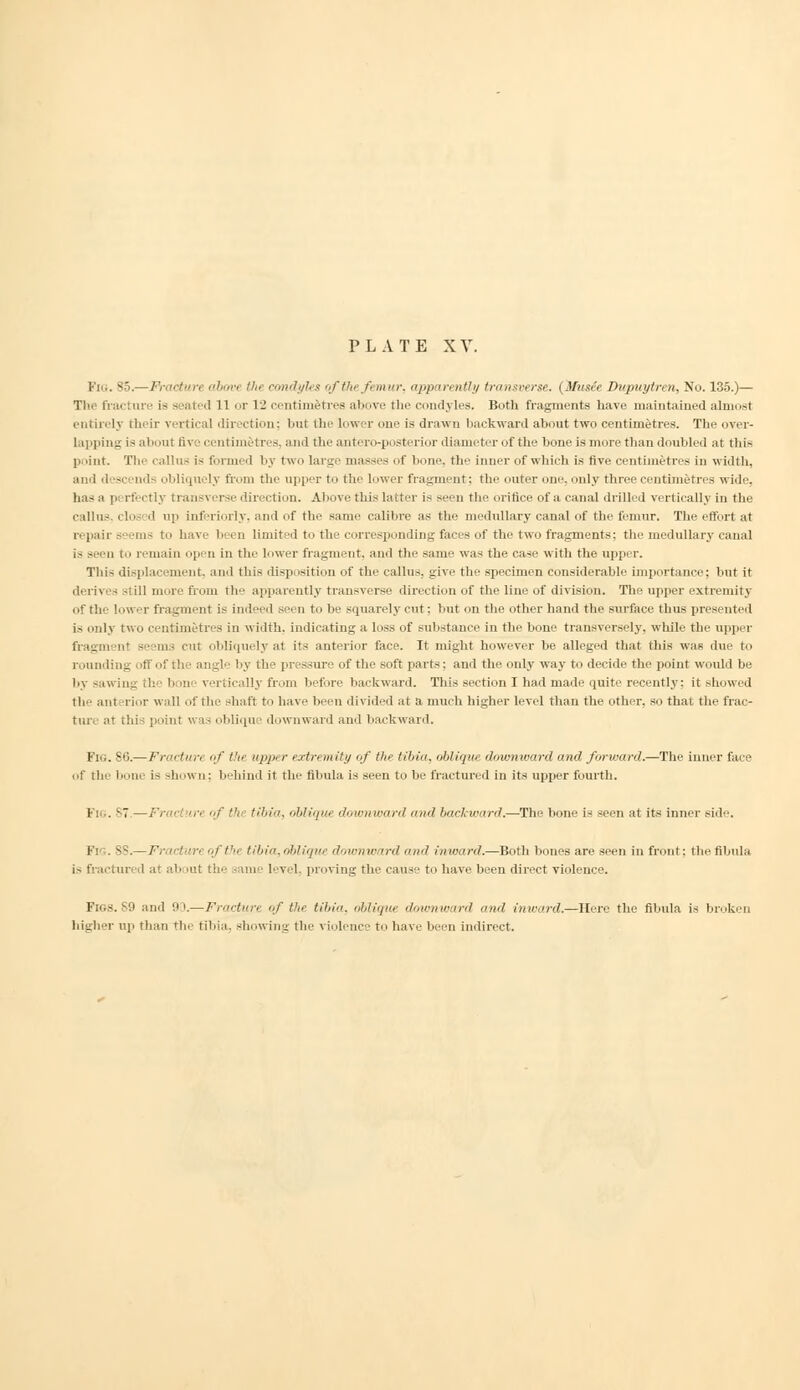 ondyh t of flu f mur, apparently transverse. (Musie Dupuytren, No. 135.)— i seated 11 or 12 centimetres above the condyles. Both fragments have maintained almost entirely their vertical direction; but the lower one is drawn backward about two centimetres. The over- Lapping is about five centimetres, and the antero-posterior diameter of the bone is more than doubled at this point. The callus is formed by two large masses of bone, th inner of which is five centimetres in width, no- obliquely from the upper to the lower fragment; the outer one. only three centimetres wide, has a perfectly transverse direction. Above this latter is seen the orifice of a canal drilled vertically in the callus, clo- .1 up inferiorly, and of the same calibre as the medullary canal of the femur. The effort at repail - m- to have Ir.ii limited to the corresponding faces of the two fragments; the medullary canal is seen to remain open in the lower fragment, and the same was the case with the upper. This displacement, and this disposition of the callus, give the specimen considerable importance; but it derives still more from the apparently transverse direction of the line of division. The upper extremity of the lower fragment is indeed seen to be squarely cut: but on the other hand the surface thus presented is only two centimetres in width, indicating a loss of substance in the bone transversely, while the upper -••in- cut obliquely at its anterior face. It might however be alleged that this was due to rounding off of the angle by the pressure of the soft parts; and the only way to decide the point would be by sawing the bone vertically from before backward. This section I had made quite recently: it showed tic ant rior wall of the shaft to have 1 n divided at a much higher level than the other, so that the frac- ture at this point was oblique downward and backward. Fig. 86.— Fractun of the upp r extremity of the tibia, oblique downward and forward.—The inner face of the bone is shown; behind it the fibula is seen to be fractured in its upper fourth. I■: .87- -Fra< m of tht tibia, obliqut downward and backward.—The bone is seen at its inner side. vftfu tibia,oblique downward and inward.—Both bones are seen in front: the fibula is fractured at about the same level, proving the cause to have been direct violence. PiGS. 89 and 93.— Fracture of the tibia, oblique downward and inward.—Here the fibula is broken high!' up than rhi tibia, showing the violence to have been indirect.