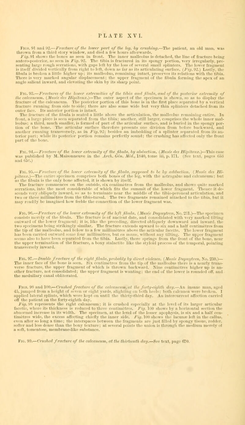 Figs. 91 and 92.— Fracture of the lower pari oftht leg, by crushing.—The patient, an old man. was thrown from a third Btory window, and died a few hours afterwards. /'/./.mi shows the 1 es as seen in front. The inner malleolus is detached, the Iii f fracture being antero-posterior, as seen in Fig.92. The tibia is fractured in iis spongy portion, very irregularly, pre- senting Large rough Berrations, witb gaps left by the loss of several small splinters. The lower fragment is itself divided vertically from right to left, down as far as its articulating surface, i Fig. 92.) Last! tilmla is broken a little higher up; iis malleolus, remaining intact, preserves its relations with the tibia. There is very marked angular displacement; the upper frag nt of the Bbula forming the apex of an angle salient inward, and elevating tin-skin by its sharp point. Fig. 93.— Fractures of the lower extremities of the tibia and fibula, and of the posterior extremity of the calcaneum. (Musie des HGpitaux.)—The outer aspect of the specin shown so as to display the fracture of the calcaneum. The posterior portion of this I is in the first place separati d bj e vertical fracture running from shir to side; there are also some wide bui very thin splinters detached iron: its outer face. Its anterior portion is intact. The fracture of the film la is Beated a little above the articulation, the malleolus remaining entire. In front, a I irg piece is Been separated from the tibia; another, still larger, comprises the whole inner mal- leolus; a third, much smaller, is formed of pari of the articular surface, and is buried in the spongj por- tion of the bone. The articular Burface therefore presents one division from before backward, and another running transversely, as in Fig.92; besides an imbedding of a splinter separated fr its an- terior part: while its posterior portion remains perfectly sound: the crushing has affected only the front par! of the hone. Fig. 94.— Fracture of the lower extremity of the fibula, by abduction, i Musee des Hopitaux.)—This i a e was published by M. Maisonneuve in the Arch.Qen. Mid., 1840, tome iii, p. 171. (See text, pages 853 and (J5t:.) Fig. 95.—Fracture of the lower extremity of ifu fibula, supposed to be by adduction. (Musie des /!■'- pitaux.)—The entire specimen comprises both bones of the leg, with the a tragalu and calcaneum; but as tin Bbula is the only hone affected, it is shown by itself. The fracture commences on the outside, six centimetres from the malleolus, and shows quite marked .serrations, into the most considerable of which tils the summit of the lower fragment. Thence it de- scends verj obliquely inward, so as to terminate near the middle of the tibio-peroneal articulation, and two or three millimetres from the tibio-tarsal. The two fragments remai I attached to the tibia, but it may readily be imagined how feeble the connection of the lower fragment was. Fig. 96.— Fracture of tlu lowi r extn mity of the left fibula. | Itusie Vupuytn n, No. 231.)—The spei i consists merely of the fibula. The fracture is of ancient date, and consolidated with very marked tilting outward of the lower fragment; it is. like the preceding, directed obliquely downward and inward, the two specimens being strikingly similar. The fracture extends upward to six and a half centimetres from the tip of the malleolus, and below to a few millimetres above the articular facette. The lowet fragment has been carried outward some four millimetres, hut en masse, without any tilting. The uppei fragment si ems also to have been separated from the tibia. Lastly, there Bprings from the front of the hone, near the upper termination of the fracture, a bony stalactite like the styloid process of the I imporal, pointing transversely inward. Fig. 97.—Double fracture of the right fibula, probably by direct violence. {Mv • i -. No. 230.)— The inter face of the bone is seen. Six centimetres from the tip of the malleolus there is a aearbj trans- verse fracture, tin- upper fragment of which is tin-own backward. Nine centim fcres higher up i- an- other fracture, not consolidated; the upper fragment is wanting; the end of the lower is rounded off, and the medullary canal obliterated. Figs. 98 and 100.—Crushed fracturt ofth< calcaneum,at tin forty-eighth day. An insane man. 45, jumped from a height of vi a oi ighf yards, alighting on both heel-.: both calcanea were broken. I applied lateral splint-, which were kept on until the thirty-third day. An intercurrent affection carried oil tin patient on the forty-eighth day. FUj. vis represents (he rt um; it is crushed especially at the level of its larger articular facette, where its thickness is reduced to three centimetres. Fig. I 0 Bhows bj a horizontal Bection the abnormal increase in it- width. 'The Bpeci n, at the level of the lesser apophysis, is six and a half cen- timetres wide, the excess affecting chiefly the inner side. Fig. 100 shows the lacunae left in the callus, even after so long a time; the inter-pare, between the fragment - are just filled by spongy tissue, redder, softer and less dense than the bony texture; at several point- the union i- through the medium merely oi a -it. t iii , membrane-like substance. Fig. 9 I.—Crushed fracturt of On calcan* um, at tht thirteenth day.—See trxt. page 670.