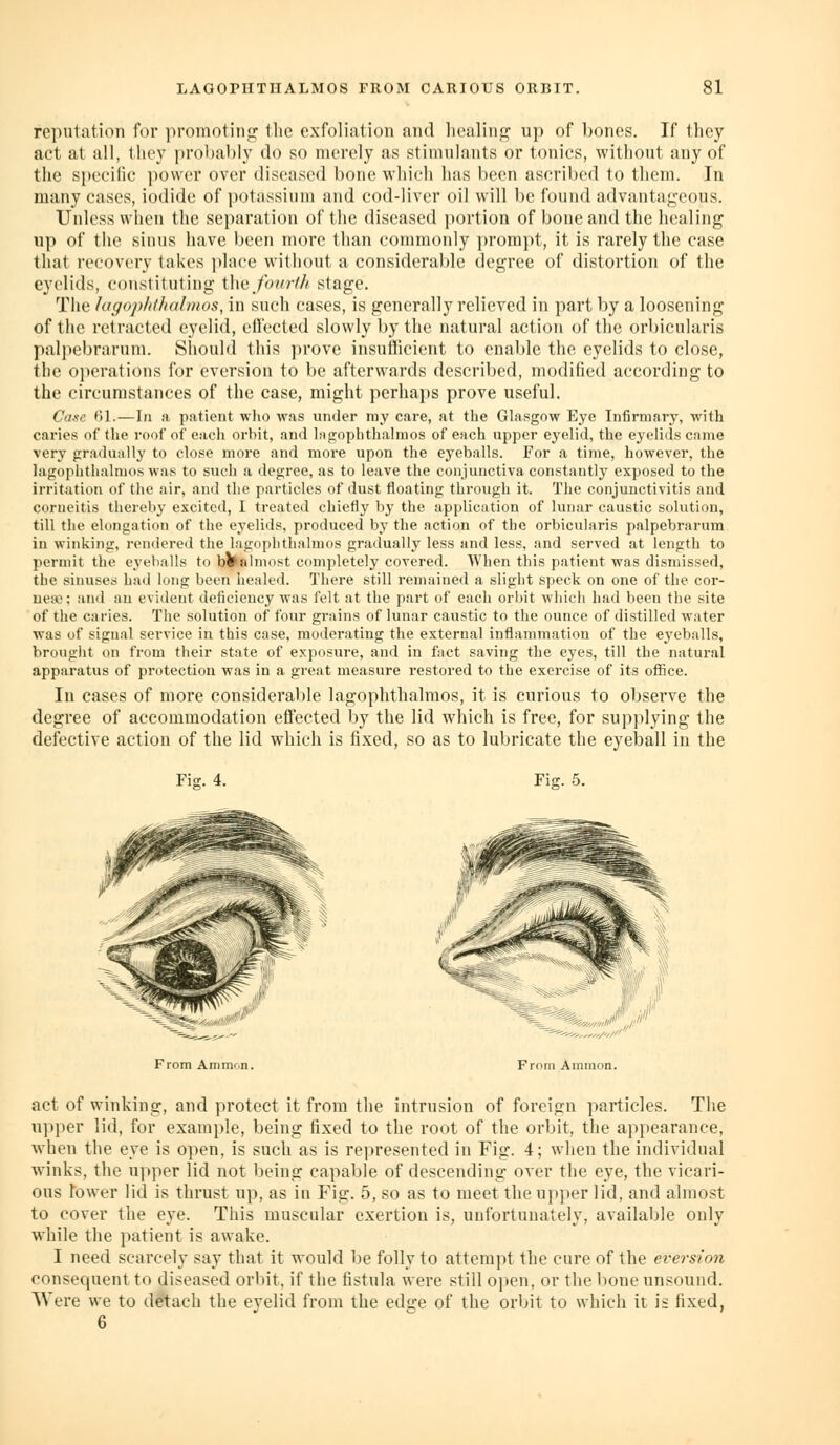 reputation for promotino; llic exfoliation and liealinp^ up of bones. If they act at all, tlie\' pi'()l)a1)ly do so merely as stimulants or tonics, without any of the specilic power over diseased bone which has been ascribed to them. In many cases, iodide of ))otassium and cod-liver oil will l)e found advantageous. Unless when the separation of the diseased i)ortion of bone and the healing up of the sinus have been more than commonly })rompt, it is rarely the case that recovery takes ])]ace without a considerable degree of distortion of the eyelids, constituting i\wfovrth stage. The lagophfhahnos, in such cases, is generally relieved in part by a loosening of the retracted eyelid, effected slowly by the natural action of the orbicularis palpebrarum. Should this prove insuflicient to enable the eyelids to close, the operations for eversion to be afterwards described, modified according to the circumstances of the case, might perhaps prove useful. Case HI.—\n a patient who was under my care, at the Ghasgow Eye Infirmary, with caries of the roof of eacli orbit, and lagoplithalmos of each upper eyelid, the eyelids came very gradually to elo.se more and more upon tlie eyeballs. For a time, however, the lagoplithalmos was to such a degree, as to leave the conjunctiva constantly exposed to the irritation of the air, and the particles of dust floating through it. The conjunctivitis and corueitis thereby excited, 1 treated chiefly by the application of lunar caustic solution, till the elongatio!! of the eyelids, produced by the action of the orbicularis palpebrarum in winking, rendered the lagoplithalmos gradually less and less, and served at length to permit the eyeballs to b¥alniost completely covered. When this patient was dismissed, the sinuses had long been healed. There still remaineil a slight speck on one of the cor- ueso: and an evitlent deficiency was felt at the part of each orbit which had been the site of the caries. The solution of four grains of lunar caustic to the ounce of distilled water was of signal service in this case, moderating the external inflammation of the eyeballs, brought on from their state of exposure, and in fact saving the eyes, till the natural apparatus of protection was in a great measure restored to the exercise of its office. In cases of more considerable lagoplithalmos, it is curious to observe the degree of accommodation effected by the lid which is free, for supplying the defective action of the lid which is fixed, so as to lubricate the eyeball in the Fig. 4. Fig. 5. From Ammon. From Ammon. act of winking, and protect it from the intrusion of foreign particles. The upper lid, for example, being fixed to the root of the orbit, the appearance, when the eye is open, is such as is represented in Fig. 4; when the individual winks, the upper lid not being capable of descending over the eye, the vicari- ous Tower lid is thrust up, as in Fig. 5, so as to meet the upper lid, and almost to cover the eye. This muscular exertion is, unfortunately, available only while the patient is awake. I need scarcely say that it would be folly to attempt the cure of the eversion consequent to diseased orbit, if the fistula were still open, or the bone unsound. Were we to detach the eyelid from the edge of the orbit to which it is fixed, 6