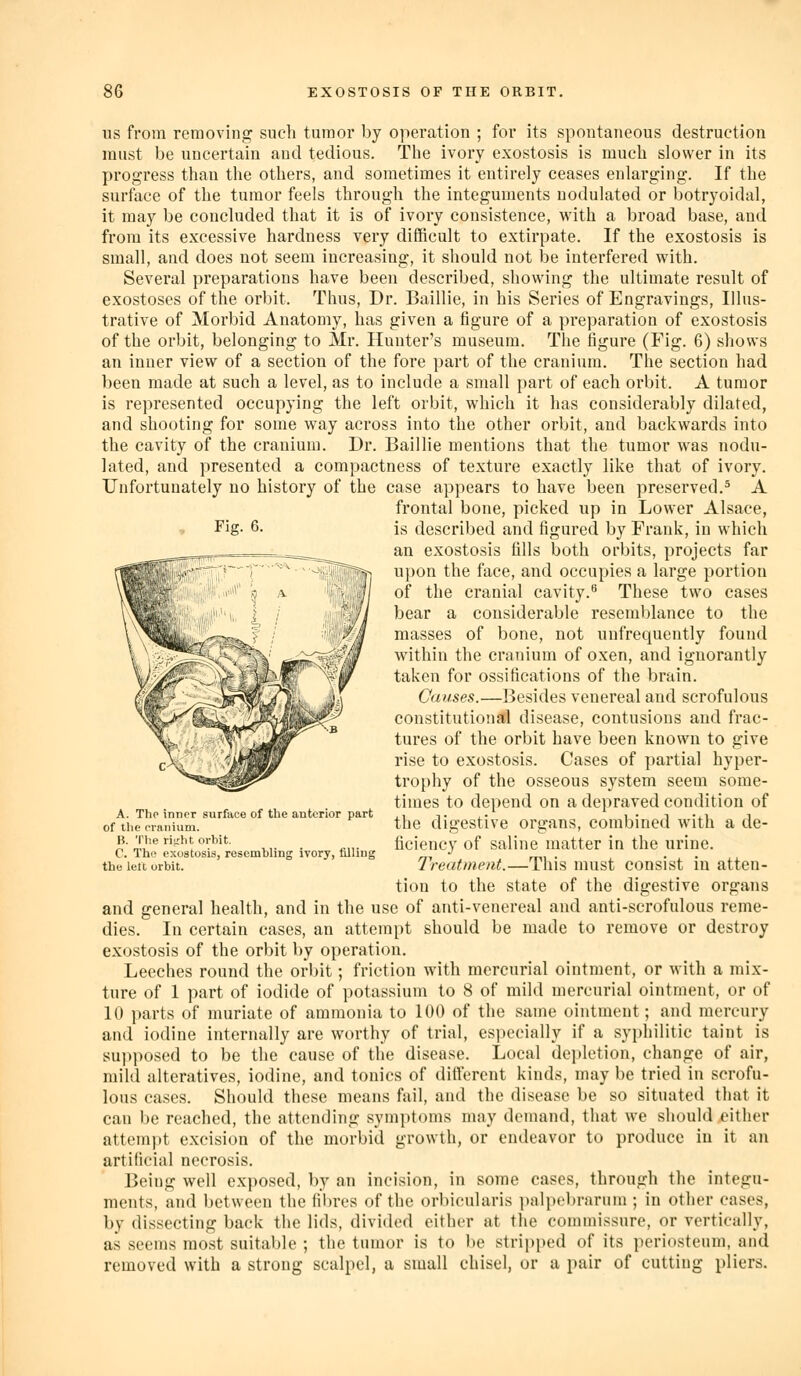 Fig. 6. US from removing such tumor by operation ; for its spontaneous destruction must be uncertain and tedious. The ivory exostosis is much slower in its progress than the others, and sometimes it entirely ceases enlarging. If the surface of the tumor feels through the integuments nodulated or botryoidal, it may be concluded that it is of ivory consistence, with a broad base, and from its excessive hardness very difficult to extirpate. If the exostosis is small, and does not seem increasing, it should not be interfered with. Several preparations have been described, showing the ultimate result of exostoses of the orl)it. Thus, Dr. Baillie, in his Series of Engravings, Illus- trative of Morbid Anatomy, has given a figure of a preparation of exostosis of the orbit, belonging to Mr. Hunter's museum. The figure (Fig. 6) shows an inner view of a section of the fore part of the cranium. The section had been made at such a level, as to include a small part of each orbit. A tumor is represented occupying the left orbit, which it has considerably dilated, and shooting for some way across into the other orbit, and backwards into the cavity of the cranium. Dr. Baillie mentions that the tumor was nodu- lated, and presented a compactness of texture exactly like that of ivory. Unfortunately no history of the case appears to have been preserved.^ A frontal bone, picked up in Lower Alsace, is described and figured by Frank, in which an exostosis fills both orbits, projects far upon the face, and occupies a large portion of the cranial cavity.^ These two cases bear a considerable resemblance to the masses of bone, not unfrequently found within the cranium of oxen, and iguorantly taken for ossifications of the brain. Causes.—Besides venereal and scrofulous constitutional disease, contusions and frac- tures of the orbit have been known to give rise to exostosis. Cases of partial hyper- trophy of the osseous system seem some- times to depend on a depraved condition of the digestive organs, combined with a de- ficiency of saline matter in the urine. Treatment.—This must consist in atten- tion to the state of the digestive organs and general health, and in the use of anti-venereal and anti-scrofulous reme- dies. In certain cases, an attempt should be made to remove or destroy exostosis of the orbit by operation. Leeches round the orbit; friction with mercurial ointment, or with a mix- ture of 1 part of iodide of potassium to 8 of mild mercurial ointment, or of 10 parts of muriate of ammonia to 100 of the same ointment; and mercury and iodine internally are worthy of trial, especially if a syphilitic taint is supposed to be the cause of the disease. Local dei»letion, change of air, mild alteratives, iodine, and tonics of diiferent kinds, may be tried in scrofu- lous cases. Should these means fail, and the disease be so situated that it can be reached, the attending symptoms may demand, that we should cither attempt excision of the morbid growth, or endeavor to produce in it an artificial necrosis. Being well exposed, by an incision, in some cases, through the integu- ments, and between the fibres of the orbicularis i)alpebrarum ; in other cases, by dissecting back the lids, divided either at the commissure, or vertically, as seems most suitable ; the tumor is to be stripped of its periosteum, and removed with a strong scalpel, a small chisel, or a pair of cutting pliers. A. Tho inner surface of the anterior part of the oianium. B. The riirht orbit. C. The exostosis, resembling ivory, filling the lell orbit.