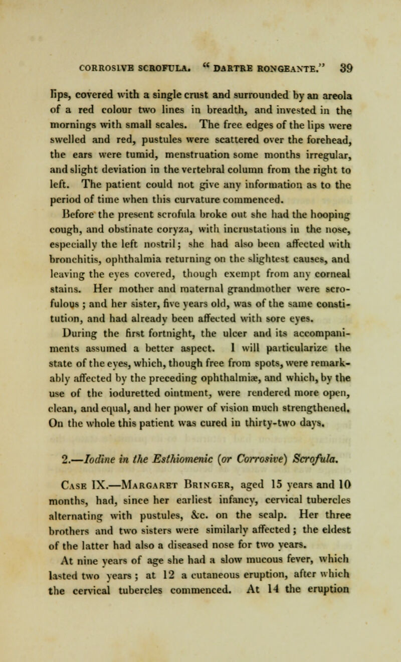 fips, covered with a single cnist and surrounded by an areola of a red colour two lines in breadth, and invested in the mornings with small scales. The free edges of the lips were swelled and red, pustules were scattered over the forehead, the ears were tumid, menstruation some months irregular, and slight deviation in the vertebral column from the right to left. The patient could not give anv information as to the period of time when this curvature commenced. Before the present scrofula broke out she had the hooping cough, and obstinate coryza, with incrustations in the nose, especially the left nostril; she had also been affected with bronchitis, ophthalmia returning on the slightest causes, and leaving the eyes covered, though exempt from any corneal stains. Her mother and maternal grandmother were scro- fulous ; and her sister, five years old, was of the same consti- tution, and had already been affected with sore eyes. During the first fortnight, the ulcer and its accompani- ments assumed a better aspect. I will particularize the state of the eyes, which, though free from spots, were remark- ably affected by the preceding ophthalmia, and which, by the use of the ioduretted ointment, were rendered more open, clean, and equal, and her power of vision much strengthened. On the whole this patient was cured in thirty-two days. 2.—Iodine in the Esthiomenic [or Corrosive) Scrofula. Cask IX.—Margaret Bringer, aged 15 years and 10 months, had, since her earliest infancy, cervical tubercles alternating with pustules, &c. on the scalp. Her three brothers and two sisters were similarly affected ; the eldest of the latter had also a diseased nose for two years. At nine vears of age she had a slow mucous fever, which lasted two years; at 12 a cutaneous eruption, after which the cervical tubercles commenced. At 14 the eruption