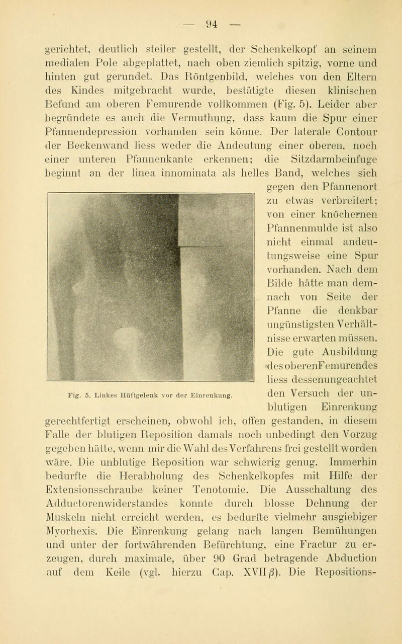 gerichtet, deutlich steiler gestellt, der Schenkelkopf an seinem medialen Pole abgeplattet, nach oben ziemlich spitzig, vorne und hinten gut gerundet. Das Röntgenbild, welches von den Eltern des Kindes mitgebracht wurde, bestätigte diesen klinischen Befund am oberen Femurende vollkommen (Fig. 5). Leider aber begründete es auch die Vermuthung, dass kaum die Spur einer Pfannendepression vorhanden sein könne. Der laterale Contour der Beckenwand liess weder die Andeutung einer oberen, noch einer unteren Pfannenkante erkennen; die Sitzdarmbeinfuge beginnt an der linea innominata als helles Band, welches sich gegen den Pfannenort zu etwas verbreitert; von einer knöchernen Pfannenmulde ist also nicht einmal andeu- tungsweise eine Spur vorhanden. Nach dem Bilde hätte man dem- nach von Seite der Pfanne die denkbar ungünstigsten Verhält- nisse erwarten müssen. Die gute Ausbildung •des oberenFemurendes liess dessenungeachtet den Versuch der un- Pig. 5. Linkes Hüftgelenk vor der Einrenkung. Einrenkung blutigen gerechtfertigt erscheinen, obwohl ich, offen gestanden, in diesem Falle der blutigen Reposition damals noch unbedingt den Vorzug- gegeben hätte, wenn mir die Wahl des Verfahrens frei gestellt worden wäre. Die unblutige Reposition war schwierig genug. Immerhin bedurfte die Herabholung des Schenkelkopfes mit Hilfe der Extensionsschraube keiner Tenotomie. Die Ausschaltung des Adductorenwiderstandes konnte durch blosse Dehnung der Muskeln nicht erreicht werden, es bedurfte vielmehr ausgiebiger Myorhexis. Die Einrenkung gelang nach langen Bemühungen und unter der fortwährenden Befürchtung, eine Fractur zu er- zeugen, durch maximale, über 90 Grad betragende Abduction auf dem Keile (vgl. hierzu Gap. XVII ß). Die Repositions-