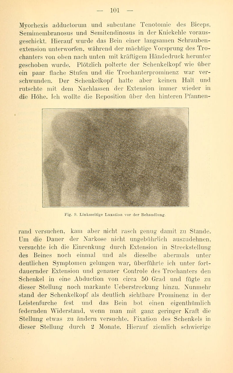 Myörhexis adductorum und subcutane Tenotomie des Biceps, Semimembranosus und Semitendinosus in der Kniekehle voraus- geschickt. Hierauf wurde das Bein einer langsamen Schrauben- extension unterworfen, während der mächtige Vorsprung des Tro- chanters von oben nach unten mit kräftigem Händedruck herunter geschoben wurde. Plötzlich polterte der Schenkelkopf wie über ein paar flache Stufen und die Trochanterprominenz war ver- schwunden. Der Schenkelkopf hatte aber keinen Halt und rutschte mit dem Nachlassen der Extension immer wieder in die Höhe. Ich wollte die Reposition über den hinteren Pfannen- Fig. 9. Linksseitige Luxation vor der Behandlung. rand versuchen, kam aber nicht rasch genug damit zu Stande. Um die Dauer der Narkose nicht ungebührlich auszudehnen, versuchte ich die Einrenkung durch Extension in Streckstellung des Beines noch einmal und als dieselbe abermals unter deutlichen Symptomen gelungen war, überführte ich unter fort- dauernder Extension und genauer Gontrole des Trochanters den Schenkel in eine Abduction von circa 50 Grad und fügte zu dieser Stellung noch markante Ueberstreckung hinzu. Nunmehr stand der Schenkelkopf als deutlich sichtbare Prominenz in der Leistenfurche fest und das Bein bot einen eigenthümlich federnden Widerstand, wenn man mit ganz geringer Kraft die Stellung etwas zu ändern versuchte. Fixation des Schenkels in dieser Stellung durch 2 Monate. Hierauf ziemlich schwierige