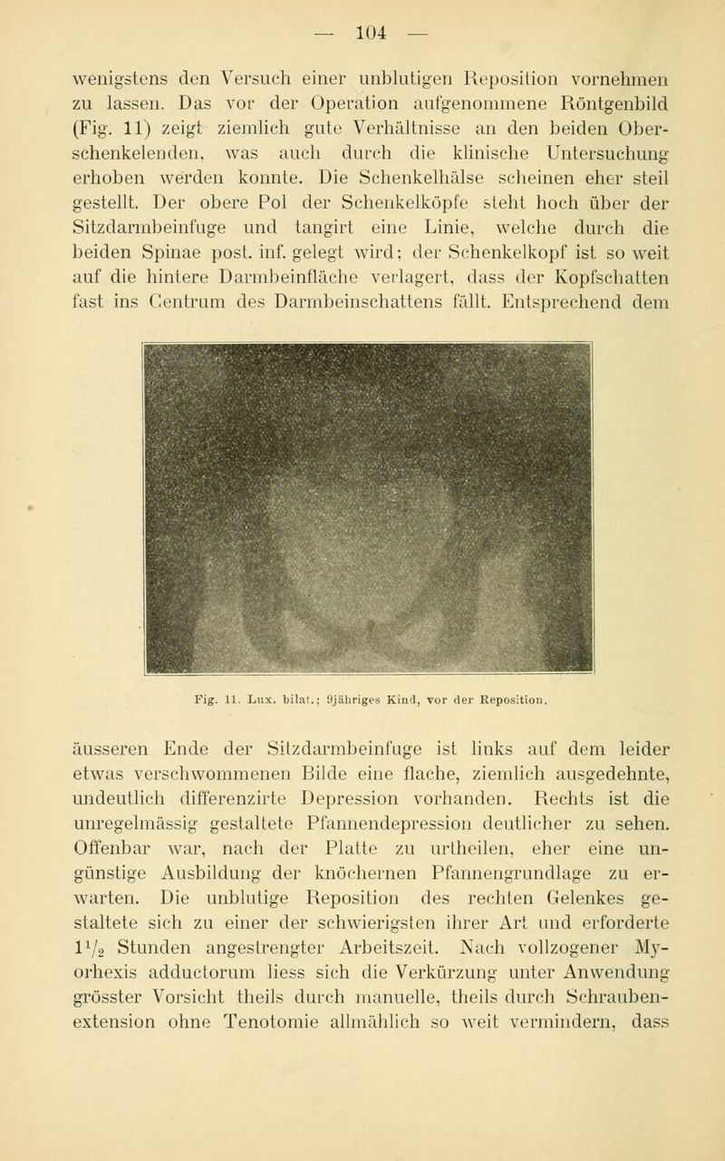 wenigstens den Versuch einer unblutigen Reposition vornehmen zu lassen. Das vor der Operation aufgenommene Röntgenbild (Fig. 11) zeigt ziemlich gute Verhältnisse an den beiden Ober- schenkelenden, was auch durch die klinische Untersuchung erhoben werden konnte. Die Schenkelhälse scheinen eher steil gestellt. Der obere Pol der Schenkelköpfe steht hoch über der Sitzdarmbeinfuge und tangirt eine Linie, welche durch die beiden Spinae post. inf. gelegt wird; der Schenkelkopf ist so weit auf die hintere Darmbeinfläche verlagert, dass der Kopfschatten fast ins Centrum des Darmbeinschattens fällt. Entsprechend dem Fig. 11. Lux. bilat.; Ojähriges Kind, vor der Reposition. äusseren Ende der Sitzdarmbeinfuge ist links auf dem leider etwas verschwommenen Bilde eine flache, ziemlich ausgedehnte, undeutlich differenzirte Depression vorhanden. Rechts ist die unregelmässig gestaltete Pfannendepression deutlicher zu sehen. Offenbar war, nach der Platte zu urtheilen, eher eine un- günstige Ausbildung der knöchernen Pfannengrundlage zu er- warten. Die unblutige Reposition des rechten Gelenkes ge- staltete sich zu einer der schwierigsten ihrer Art und erforderte IV2 Stunden angestrengter Arbeitszeit. Nach vollzogener My- orhexis adductorum liess sich die Verkürzung unter Anwendung grösster Vorsicht theils durch manuelle, theils durch Schrauben- extension ohne Tenotomie allmählich so weit vermindern, dass
