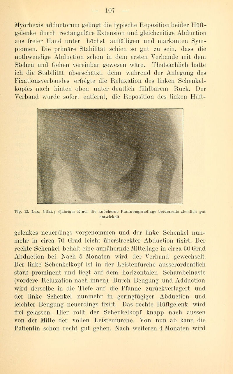 Myorhexis adductorum gelingt die typische Reposition beider Hüft- gelenke durch rectanguläre Extension und gleichzeitige Abduction aus freier Hand unter höchst auffälligen und markanten Sym- ptomen. Die primäre Stabilität schien so gut zu sein, dass die nothwendige Abduction schon in dem ersten Verbände mit dem Stehen und Gehen vereinbar gewesen wäre. Thatsächlich hatte ich die Stabilität überschätzt, denn während der Anlegung des Fixationsverbandes erfolgte die Reluxation des linken Schenkel- kopfes nach hinten oben unter deutlich fühlbarem Ruck. Der Verband wurde sofort entfernt, die Reposition des linken Hüft- Fig. 13. Lux. bilat.; 4jähriges Kind; die knöcherne Pfannengrundlage beiderseits ziemlich gut entwickelt. gelenkes neuerdings vorgenommen und der linke Schenkel nun- mehr in circa 70 Grad leicht überstreckter Abduction fixirt. Der rechte Schenkel behält eine annähernde Mittellage in circa 30 Grad Abduction bei. Nach 5 Monaten wird der Verband gewechselt. Der linke Schenkelkopf ist in der Leistenfurche ausserordentlich stark prominent und liegt auf dem horizontalen Schambeinaste (vordere Reluxation nach innen). Durch Beugung und Adduction wird derselbe in die Tiefe auf die Pfanne zurückverlagert und der linke Schenkel nunmehr in geringfügiger Abduction und leichter Beugung neuerdings fixirt. Das rechte Hüftgelenk wird frei gelassen. Hier rollt der Schenkelkopf knapp nach aussen von der Mitte der vollen Leistenfurche. Von nun ab kann die Patientin schon recht gut gehen. Nach weiteren 4 Monaten wird