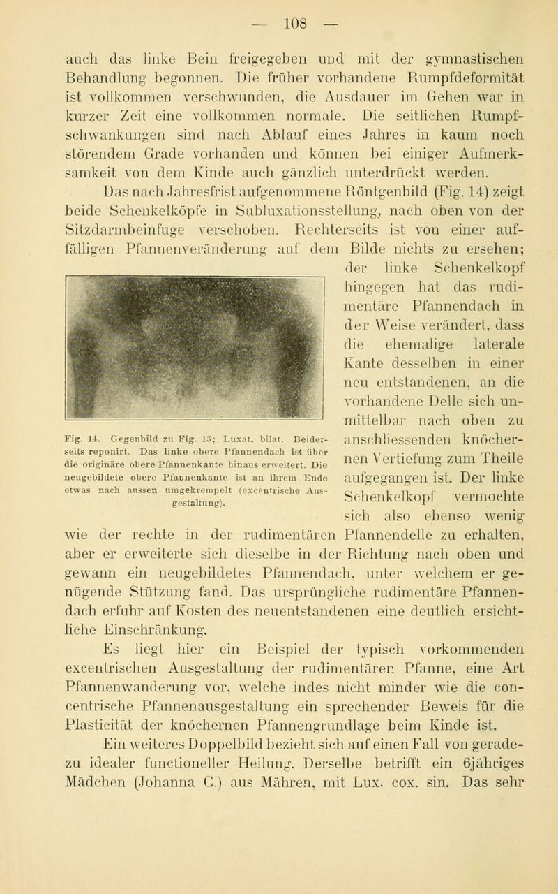 auch das linke Bein freigegeben und mit der gymnastischen Behandlung begonnen. Die früher vorhandene Rumpfdeformität ist vollkommen verschwunden, die Ausdauer im Gehen war in kurzer Zeit eine vollkommen normale. Die seitlichen Rumpf- schwankungen sind nach Ablauf eines Jahres in kaum noch störendem Grade vorhanden und können bei einiger Aufmerk- samkeit von dem Kinde auch gänzlich unterdrückt werden. Das nach Jahresfrist aufgenommene Röntgenbild (Fig. 14) zeigt beide Schenkelköpfe in Sabluxationsstellung, nach oben von der Sitzdarmbeinfuge verschoben. Rechterseits ist vou einer auf- fälligen Pfannenveränderung auf dem Bilde nichts zu ersehen; der linke Schenkelkopf hingegen hat das rudi- mentäre Pfannendach in der Weise verändert, dass die ehemalige laterale Kante desselben in einer neu entstandenen, an die vorhandene Delle sich un- mittelbar nach oben zu anschliessenden knöcher- nen Vertiefung zum Theile aufgegangen ist. Der linke S chenkelko p f vermo chte sich also ebenso wenig wie der rechte in der rudimentären Pfannendelle zu erhalten, aber er erweiterte sich dieselbe in der Richtung nach oben und gewann ein neugebildetes Pfannendach, unter welchem er ge- nügende Stützung fand. Das ursprüngliche rudimentäre Pfannen- dach erfuhr auf Kosten des neuentstandenen eine deutlich ersicht- liche Einschränkung. Es liegt hier ein Beispiel der typisch vorkommenden excentrischen Ausgestaltung der rudimentären Pfanne, eine Art Pfannenwanderung vor, welche indes nicht minder wie die con- centrische Pfannenausgestaltung ein sprechender Beweis für die Plasticität der knöchernen Pfannengrundlage beim Kinde ist. Ein weiteres Doppelbild bezieht sich auf einen Fall von gerade- zu idealer functioneller Heilung. Derselbe betrifft ein 6jähriges Mädchen (Johanna C.) aus Mähren, mit Lux. cox. sin. Das sehr Fig. 14. Gegenbild zu Fig. 13; Luxat. bilat. Beider- seits reponirt. Das linke obere Ff'annendaeh is-t über die originäre obere Pfannenkante hinaus erweitert. Die neugebildete obere Pfaonenkante hl an ihrem Ende etwas nach aussen umgekrempelt (excentrische Aus- gestaltung).