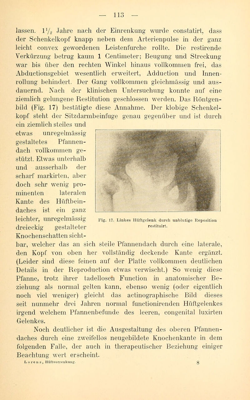 — 11- lassen. l'/2 Jahre nach der Einrenkung wurde constatirt, dass der Schenkelkopf knapp neben dem Arterienpulse in der ganz leicht convex gewordenen Leistenfurche rollte. Die restirende Verkürzung betrug kaum 1 Centimeter; Beugung und Streckung war bis über den rechten Winkel hinaus vollkommen frei, das Abductionsgebiet wesentlich erweitert, Adduction und Innen- rollung behindert. Der Gang vollkommen gleichmässig und aus- dauernd. Nach der klinischen Untersuchung konnte auf eine ziemlich gelungene Restitution geschlossen werden. Das Röntgen- bild (Fig. 17) bestätigte diese Annahme. Der klobige Schenkel- kopf steht der Sitz darmbeinfuge genau gegenüber und ist durch ein ziemlich steiles und etwas unregelmässig gestaltetes Pfannen- dach vollkommen ge- stützt. Etwas unterhalb und ausserhalb der scharf markirten, aber doch sehr wenig pro- minenten lateralen Kante des Hüftbein- daches ist ein ganz leichter, unregelmässig dreieckig gestalteter Knochenschatten sicht- bar, welcher das an sich steile Pfannendach durch eine laterale, den Kopf von oben her vollständig deckende Kante ergänzt. (Leider sind diese feinen auf der Platte vollkommen deutlichen Details in der Reproduction etwas verwischt.) So wenig diese Pfanne, trotz ihrer tadellosen Function in anatomischer Be- ziehung als normal gelten kann, ebenso wenig (oder eigentlich noch viel weniger) gleicht das actinographische Bild dieses seit nunmehr drei Jahren normal functionirenden Hüftgelenkes irgend welchem Pfannenbefunde des leeren, congenital luxirten Gelenkes. Noch deutlicher ist die Ausgestaltung des oberen Pfannen- daches durch eine zweifellos neugebildete Knochenkante in dem folgenden Falle, der auch in therapeutischer Beziehung einiger Beachtung wert erscheint. Lorenz, Hüftverrenkung. Q Fig. 17. Linkes Hüftgelenk durch unblutige Reposition restituirt.