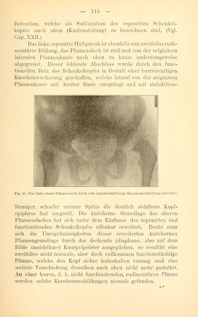 Retention. welche als Subluxation des reponirten Schenkel- kopfes nach oben (Kantenstellung) zu bezeichnen sind. (Vgl. Gap. XXII.) Das linke.reponirte Hüftgelenk ist ebenfalls von zweifellos rudi- mentärer Bildung, das Pfannendach ist steil und von der originären lateralen Pfannenkante nach oben zu kaum andeutungsweise abgegrenzt. Dieser fehlende Abschluss wurde durch den func- tionellen Pteiz des Schenkelkopfes in Gestalt einer barriereartigen Knochenwucherung geschaffen, welche lateral von der originären Pfannenkante mit breiter Basis entspringt und mit stalaktiten- Fig. IS. Das linke obere Pfannendach durch eine stalaktitenförmige Knoehenneubildtmg erweitert. förmiger, scharfer unterer Spitze die deutlich sichtbare Kopf- epiphyse fast umgreift. Die knöcherne Grundlage des oberen Pfannendaches hat sich unter dem Einflüsse des reponirten und functionirenden Schenkelkopfes offenbar erweitert. Denkt man sich die Unregelmässigkeiten dieser erweiterten knöchernen Pfannengrundlage durch das deckende (diaphane, also auf dem Bilde unsichtbare) Knorpelpolster ausgeglichen, so resultirt eine zweifellos nicht normale, aber doch vollkommen functionstüchtige Pfanne, welche den Kopf sicher festzuhalten vermag und eine weitere Verschiebung desselben nach oben nicht mehr gestattet. An einer leeren, cl. h. nicht functionirenden, rudimentären Pfanne werden solche Knochenneabildungen niemals gefunden. 8*