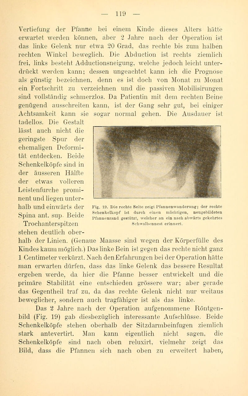 Vertiefung der Pfanne bei einem Kinde dieses Alters hätte erwartet werden können, aber 2 Jahre nach der Operation ist das linke Gelenk nur etwa 20 Grad, das rechte bis zum halben rechten Winkel beweglich. Die Abduction ist rechts ziemlich frei, links besteht. Adductionsneigung. welche jedoch leicht unter- drückt werden kann; dessen ungeachtet kann ich die Prognose als günstig bezeichnen, denn es ist doch von Monat zu Monat ein Fortschritt zu verzeichnen und die passiven Mobilisirungen sind vollständig schmerzlos. Da Patientin mit dem rechten Beine genügend ausschreiten kann, ist der Gang sehr gut, bei einiger Achtsamkeit kann sie sogar normal gehen. Die Ausdauer ist tadellos. Die Gestalt lässt auch nicht die geringste Spur der ehemaligen Deformi- tät entdecken. Beide Schenkelköpfe sind in der äusseren Hälfte der etwas volleren Leistenfurche promi- nent und liegen unter- halb und einwärts der Spina ant. sup. Beide Trochanterspitzen stehen deutlich ober- halb der Linien. (Genaue Maasse sind wegen der Körperfülle des Kindes kaum möglich.) Das linke Bein ist gegen das rechte nicht ganz 1 Centimeter verkürzt. Nach den Erfahrungen bei der Operation hätte man erwarten dürfen, dass das linke Gelenk das bessere Resultat ergeben werde, da hier die Pfanne besser entwickelt und die primäre Stabilität eine entschieden grössere war; aber gerade das Gegentheil traf zu. da das rechte Gelenk nicht nur weitaus beweglicher, sondern auch tragfähiger ist als das linke. Das 2 Jahre nach der Operation aufgenommene Röntgen- bild (Fig. 19) gab diesbezüglich interessante Aufschlüsse. Beide Schenkelköpfe stehen oberhalb der Sitzdarmbeinfugen ziemlich stark antevertirt. Man kann eigentlich nicht sagen, die Schenkelköpfe sind nach oben reluxirt. vielmehr zeigt das Bild, dass die Pfannen sich nach oben zu erweitert haben, Fig. 19. Die rechte Seite zeigt Pfannenwanderung; der rechte Schenkelkopf ist durch einen mächtigen, nengebildeten Pfannenrand gestützt, welcher an ein nach abwärts gekehrtes Schwalbennest erinnert.